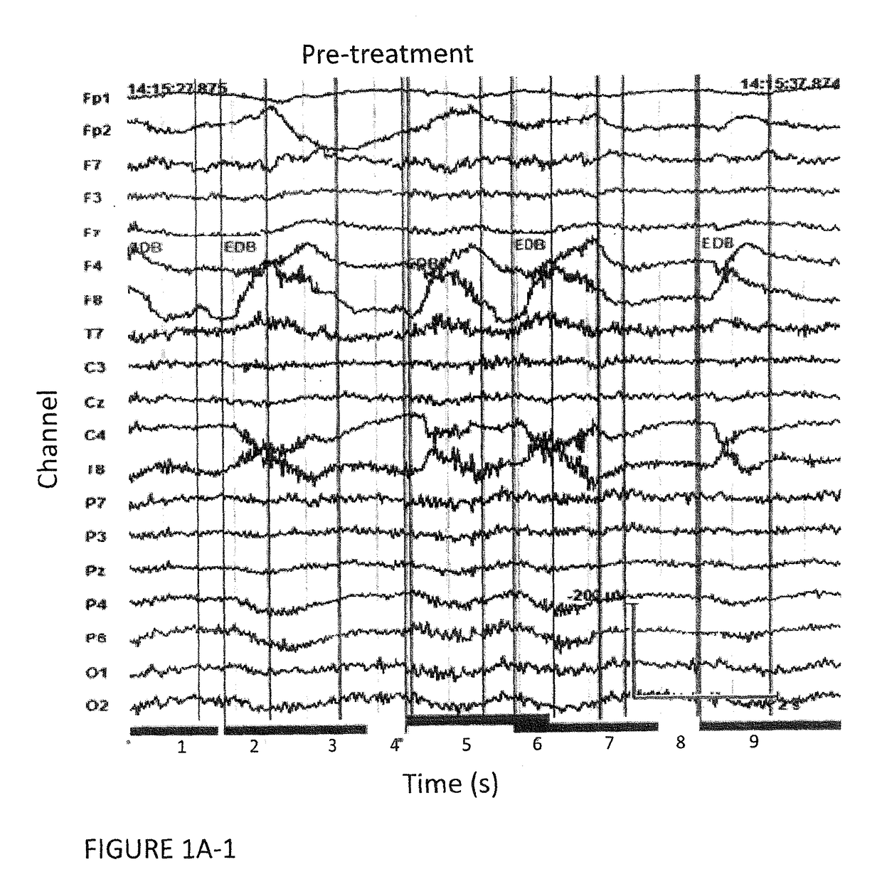 Autoimmune-induced glutamatergic receptor dysfunction methods and treatments