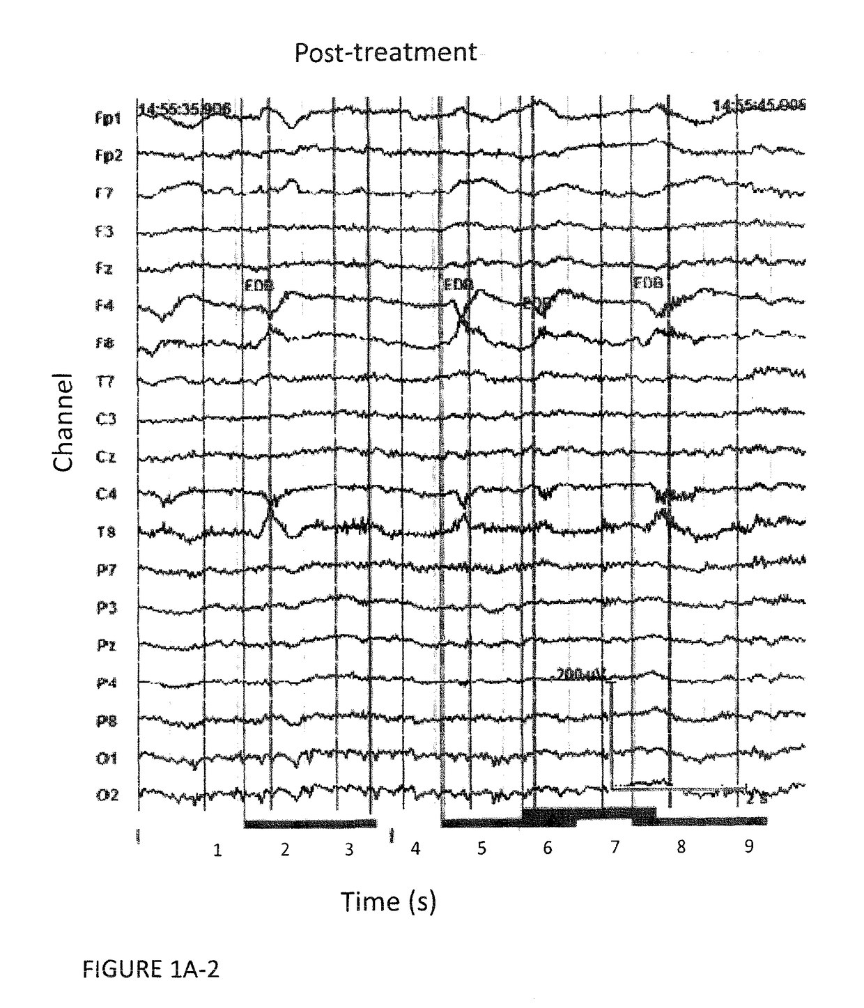 Autoimmune-induced glutamatergic receptor dysfunction methods and treatments