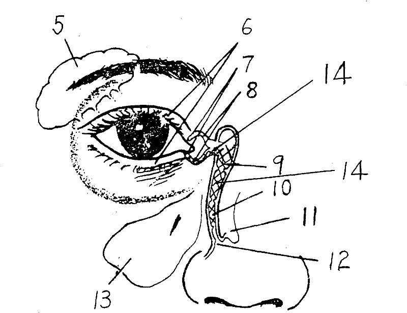 Application of medical silicone oil as medicament for treating lacrimal duct obstruction disease