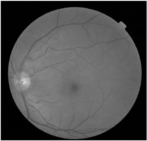 Automatic screening method for diabetic retinopathy based on naive Bayes and support vector machine