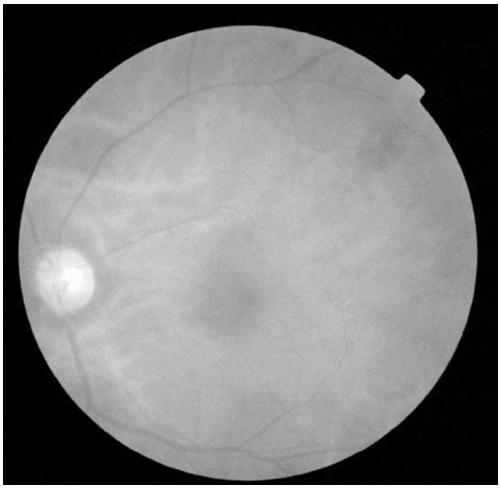 Automatic screening method for diabetic retinopathy based on naive Bayes and support vector machine