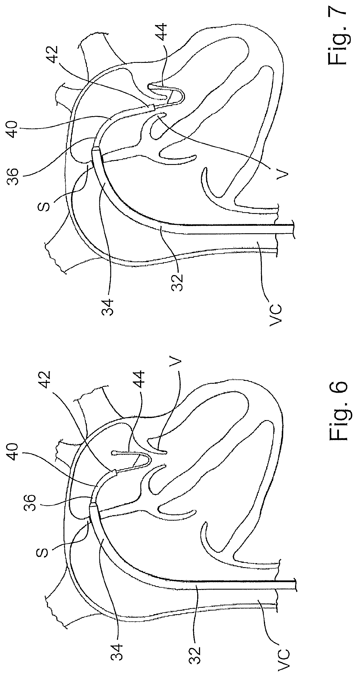 Device for implanting a prosthesis for a heart valve and assembly procedure