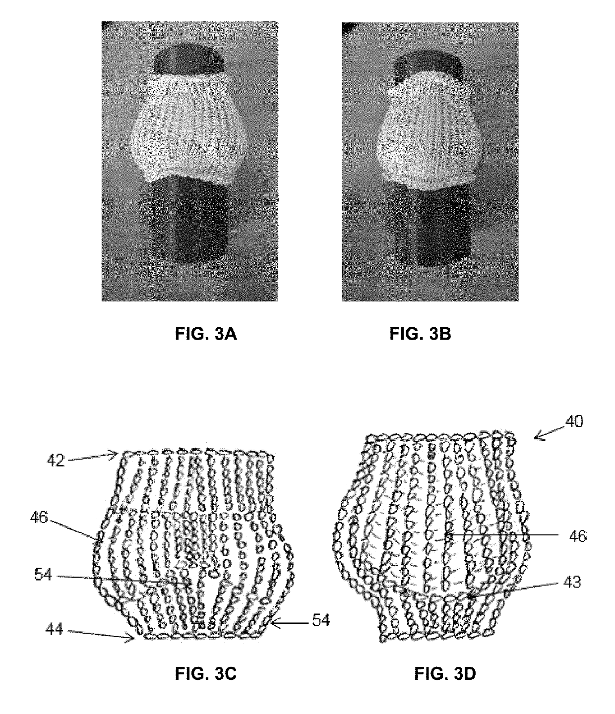 Expandable aortic or pulmonary root