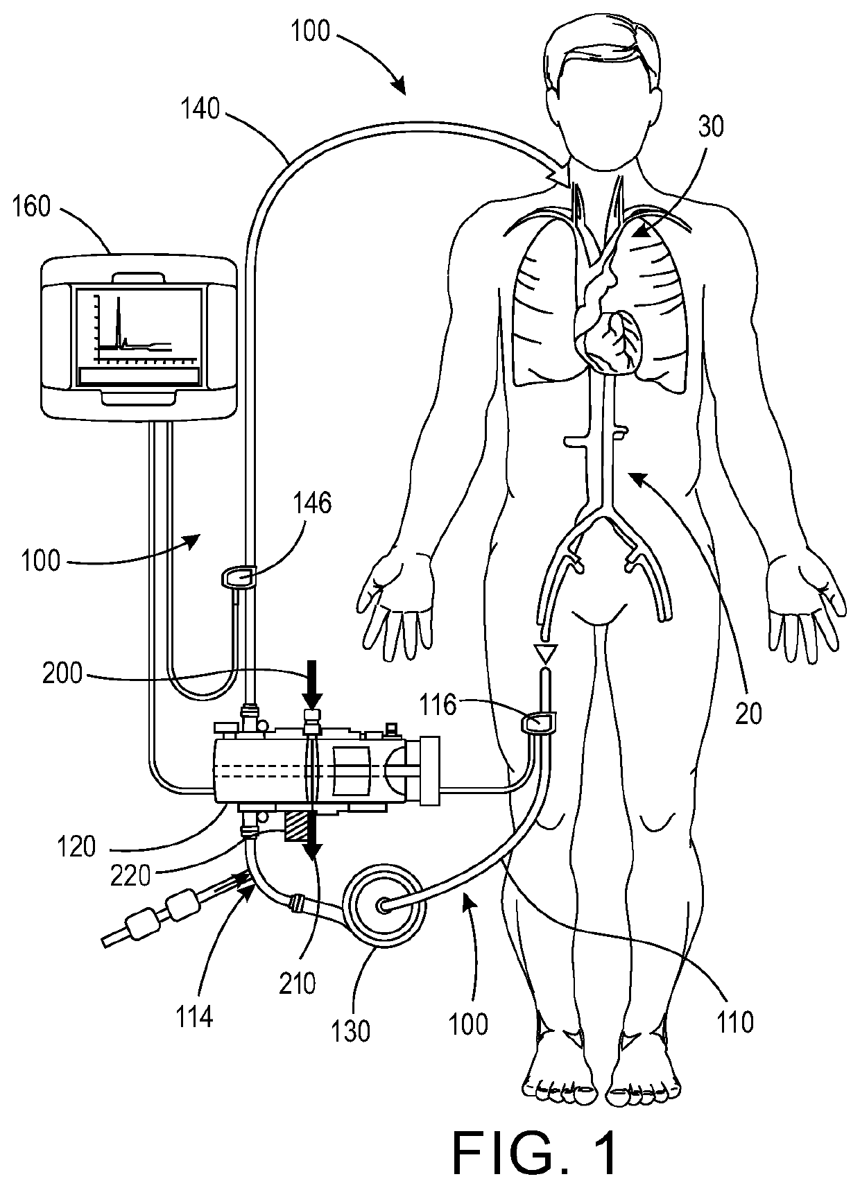 Calculating cardiac output of a patient undergoing veno-venous extracorporeal blood oxygenation