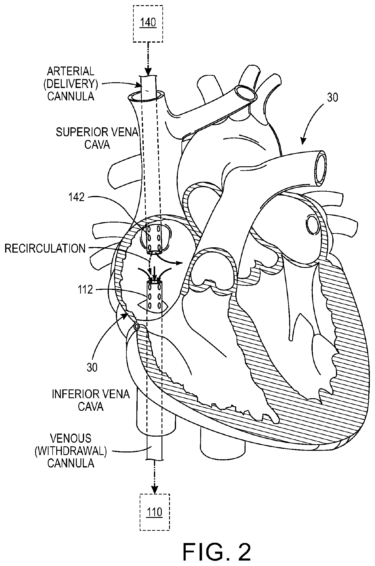 Calculating cardiac output of a patient undergoing veno-venous extracorporeal blood oxygenation