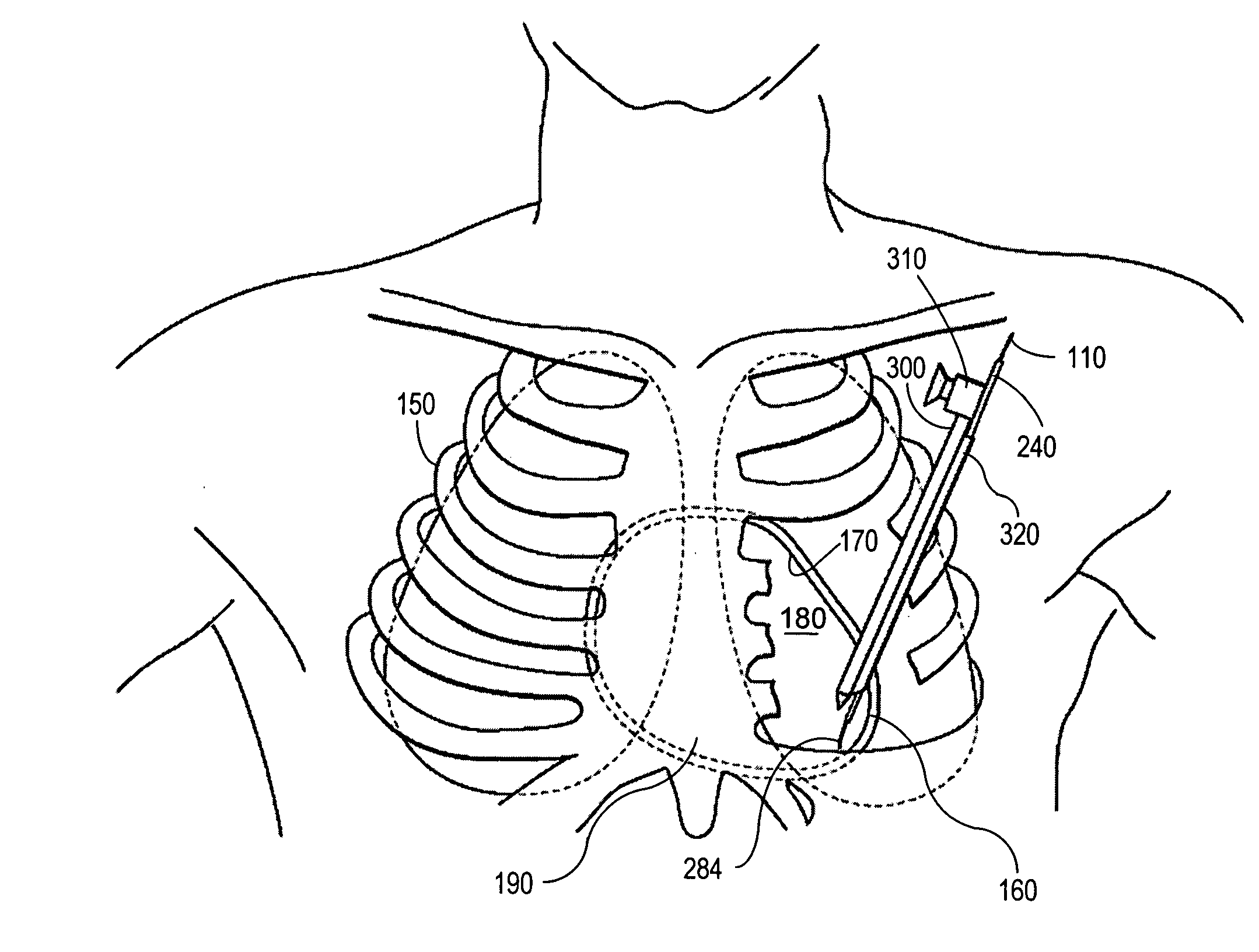 Intramyocardial lead implantation system and method