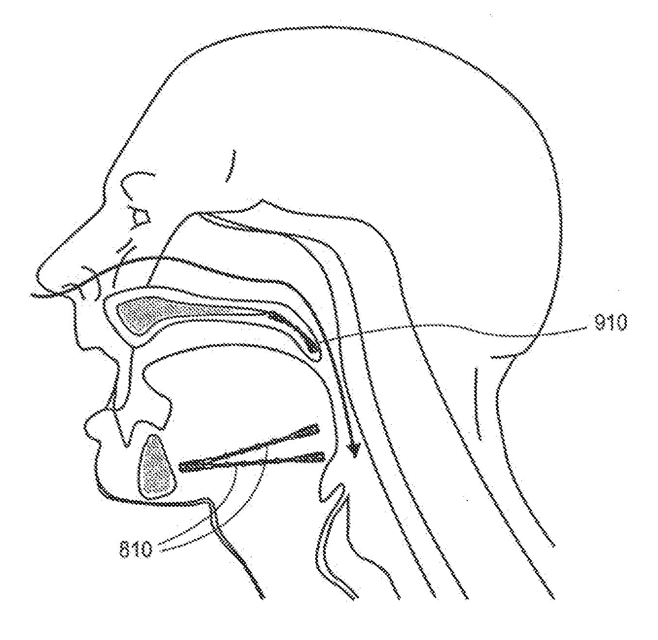 Partially erodable systems for treatment of obstructive sleep apnea