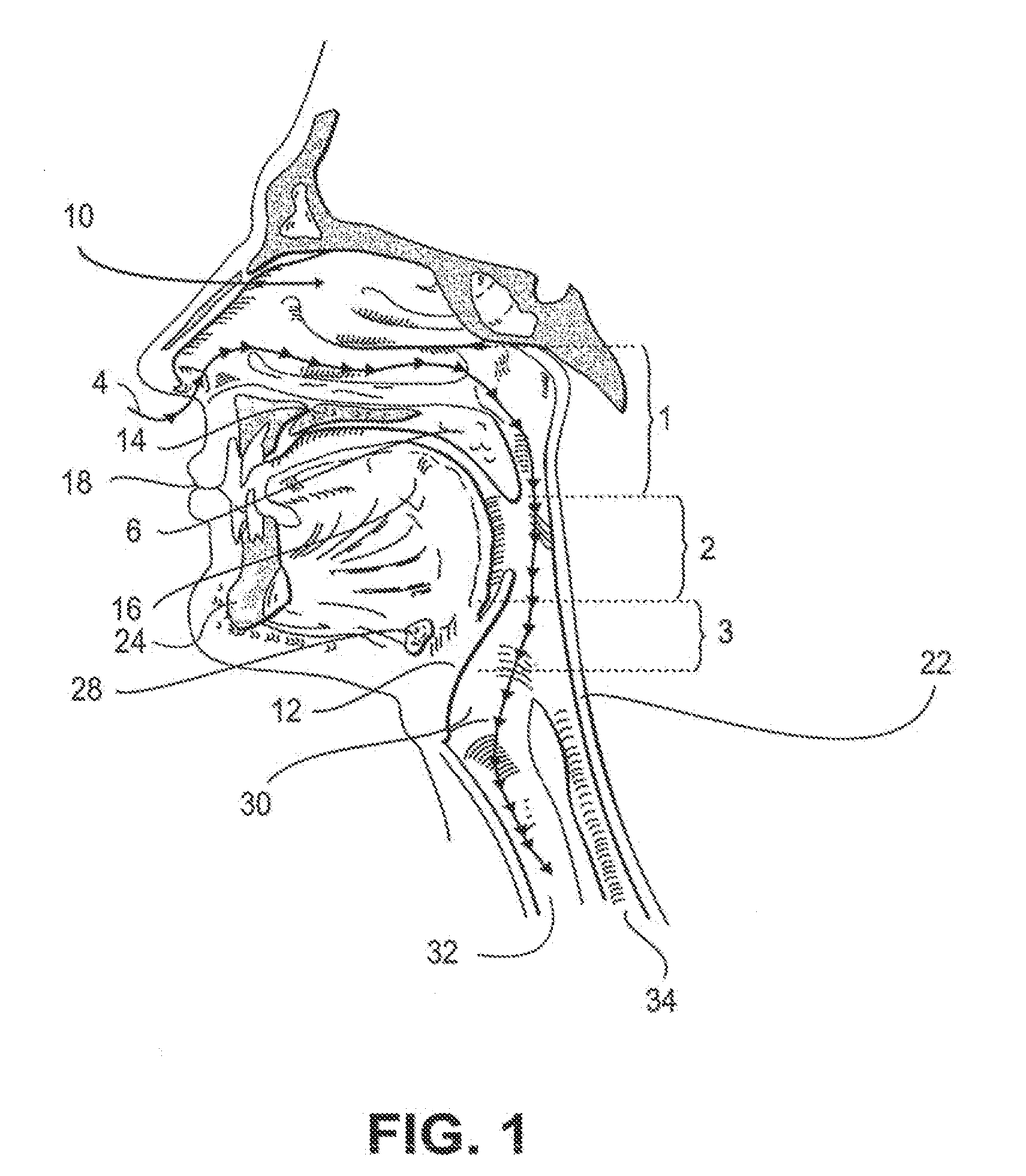 Partially erodable systems for treatment of obstructive sleep apnea