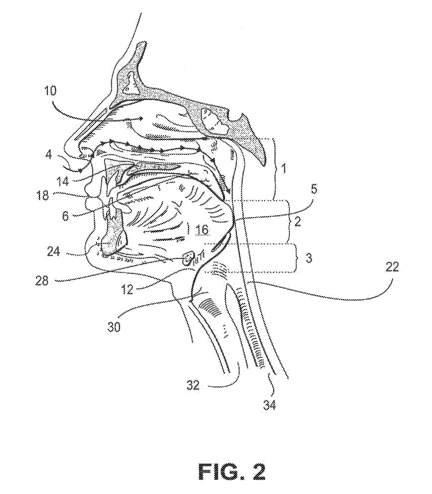 Partially erodable systems for treatment of obstructive sleep apnea