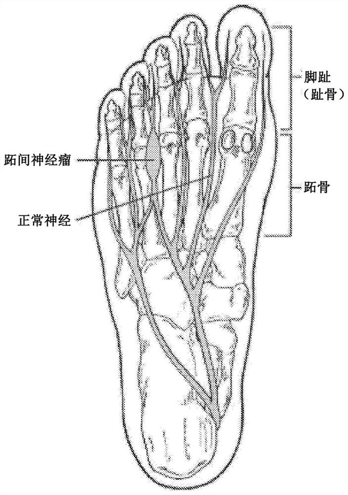 Systems and methods relating to non-surgical laser treatment of fiber masses