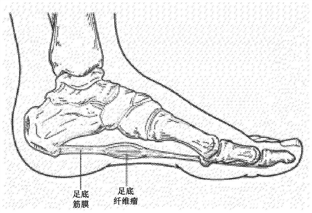 Systems and methods relating to non-surgical laser treatment of fiber masses