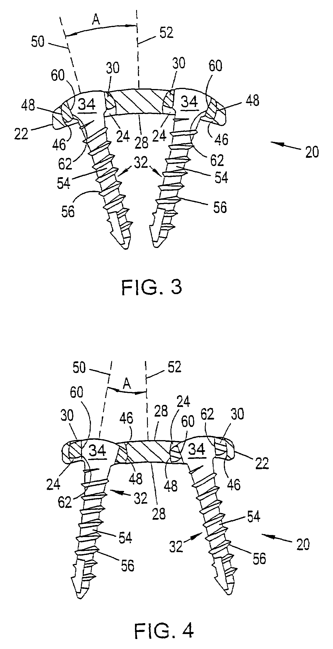 System and method for stabilizing the human spine with a bone plate