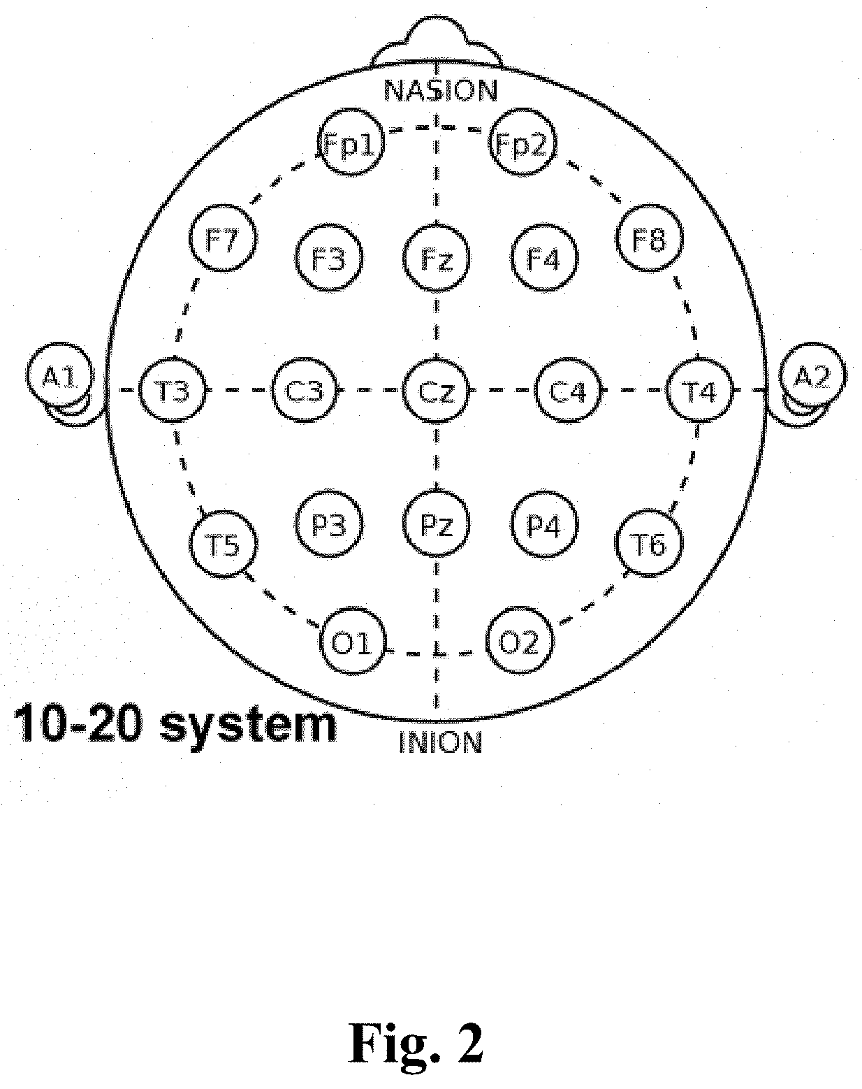 On-ear electroencephalographic monitoring device