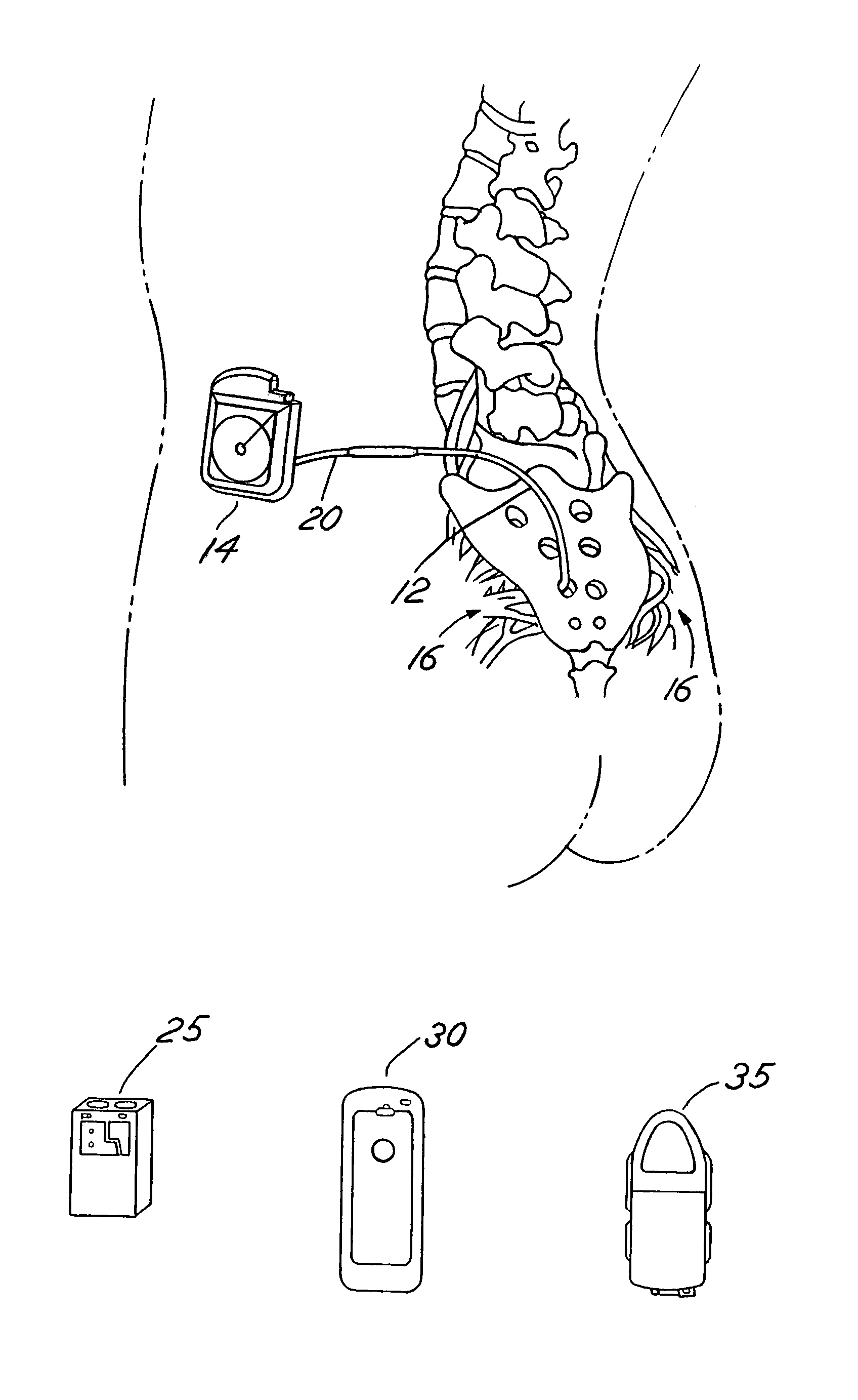 Automated impedance measurement of an implantable medical device