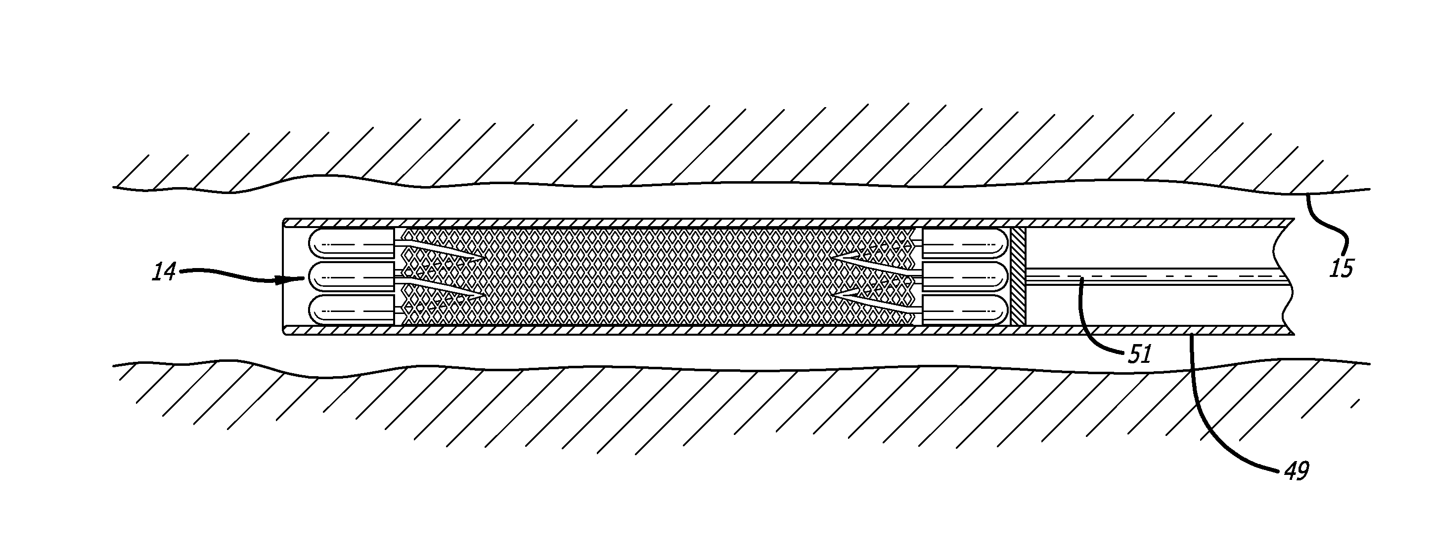 Braid expansion ring with markers