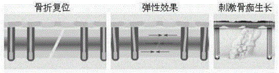 Dynamic-pressurizing-locked bone screw and use method thereof