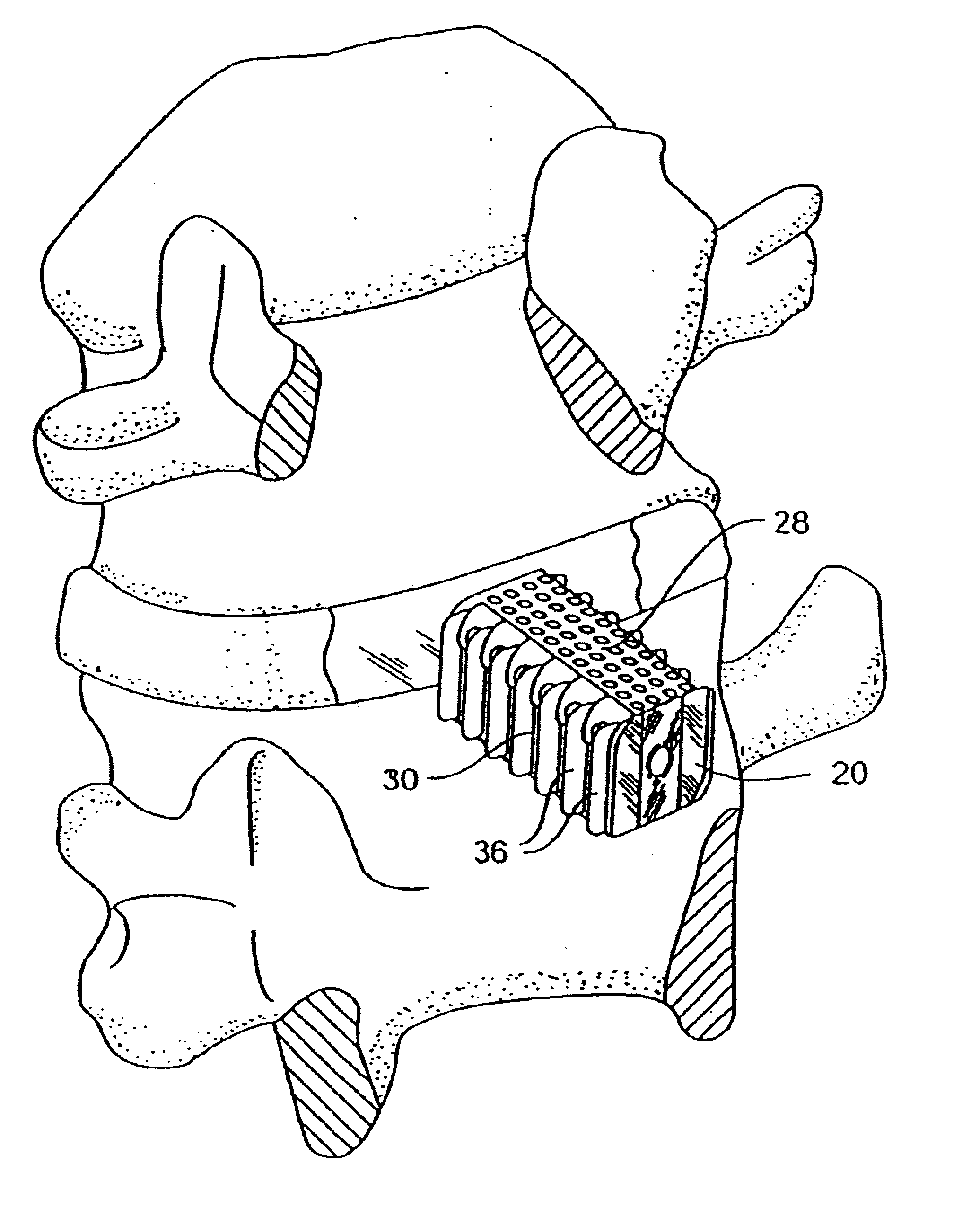 Self-broaching, rotatable, push-in interbody spinal fusion implant and method for deployment thereof