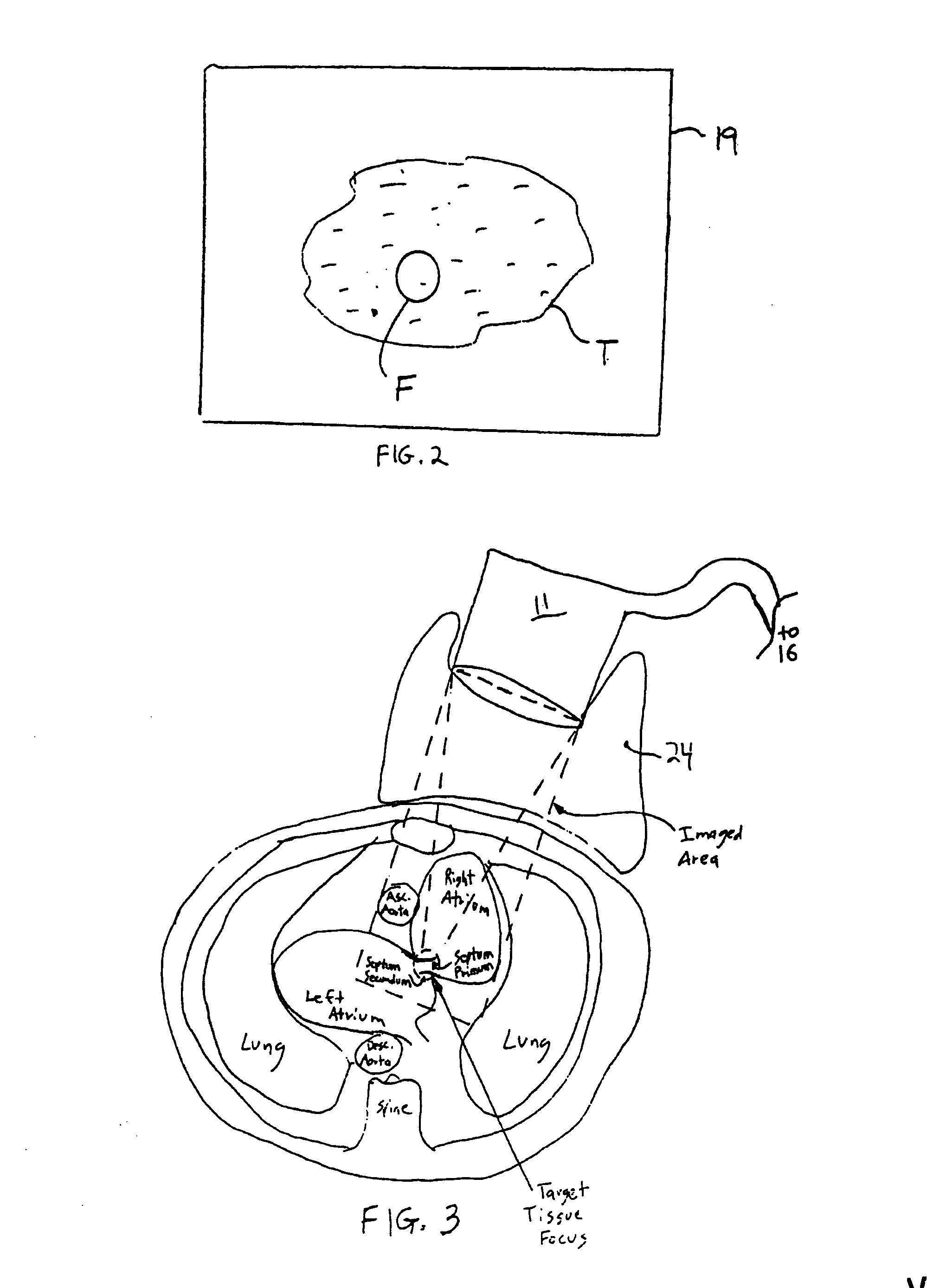 Methods and apparatus for non-invasively treating patent foramen ovale using high intensity focused ultrasound