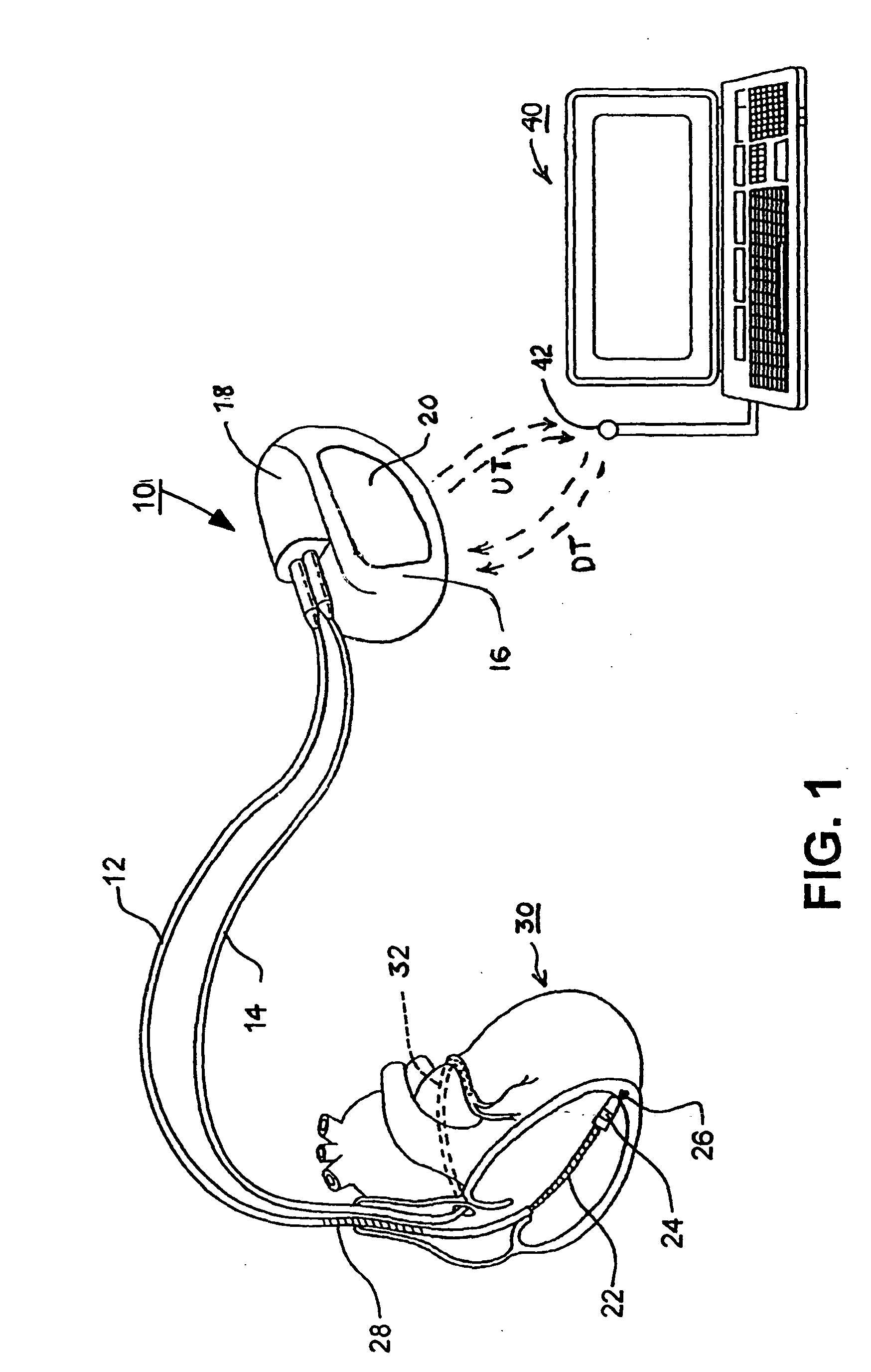 Methods and apparatus for discriminating polymorphic tachyarrhythmias from monomorphic tachyarrhythmias facilitating detection of fibrillation