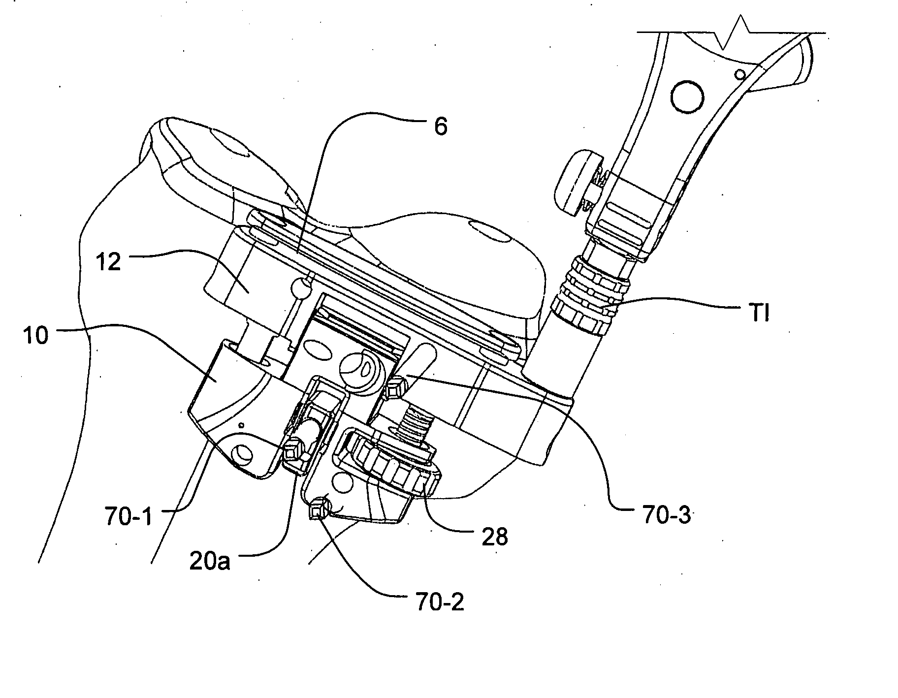 Navigated drill guided resection block