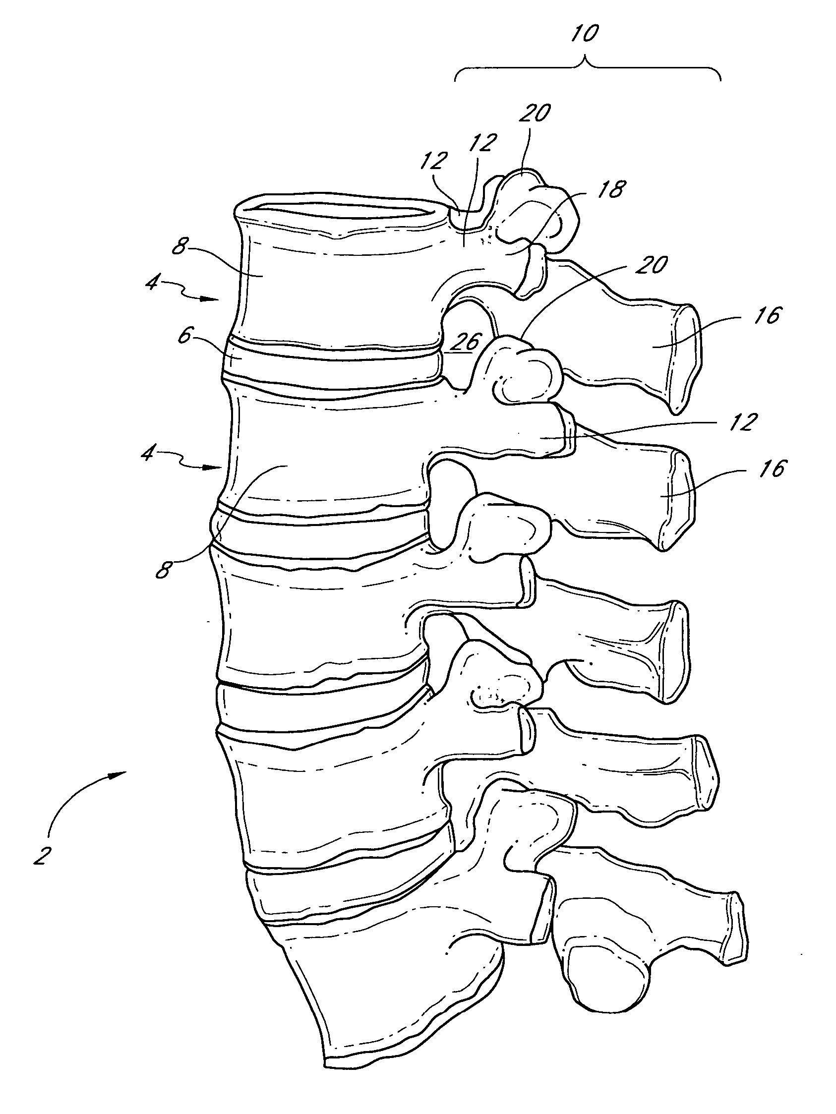 System and method for protecting neurovascular structures