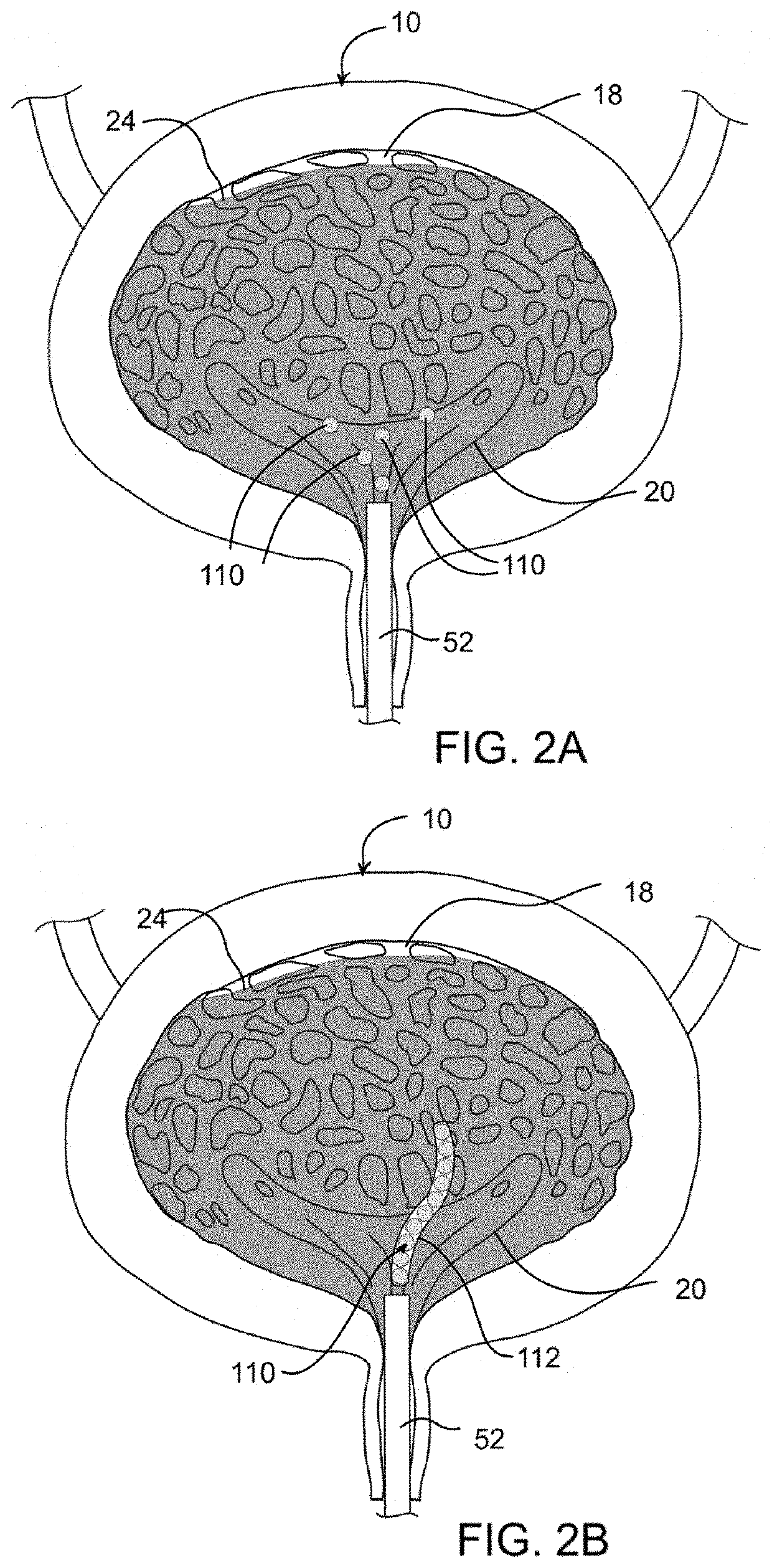 Device and method for improving retention of a therapy in the bladder