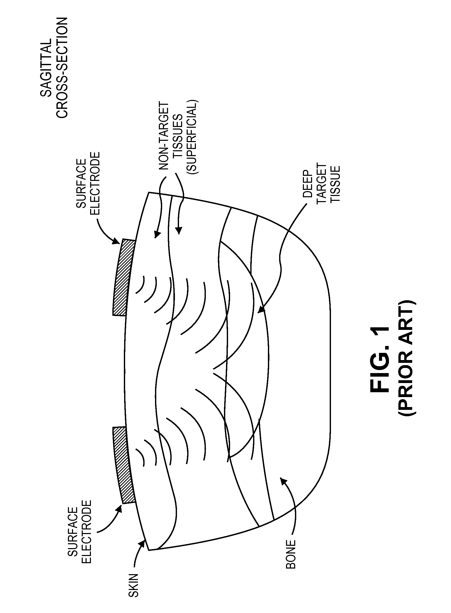 Synergistic muscle activation device