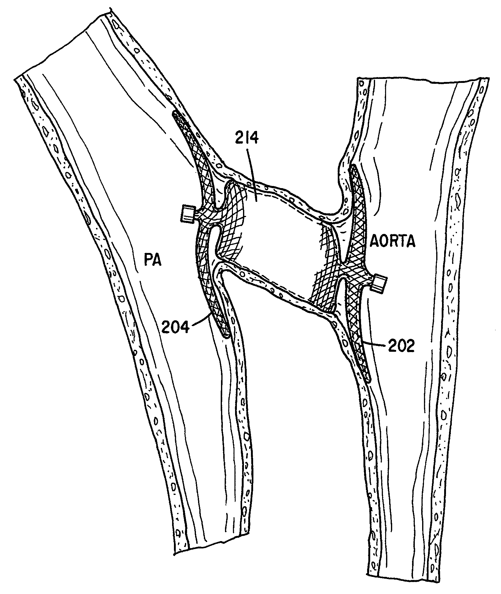 Device for occluding vascular defects