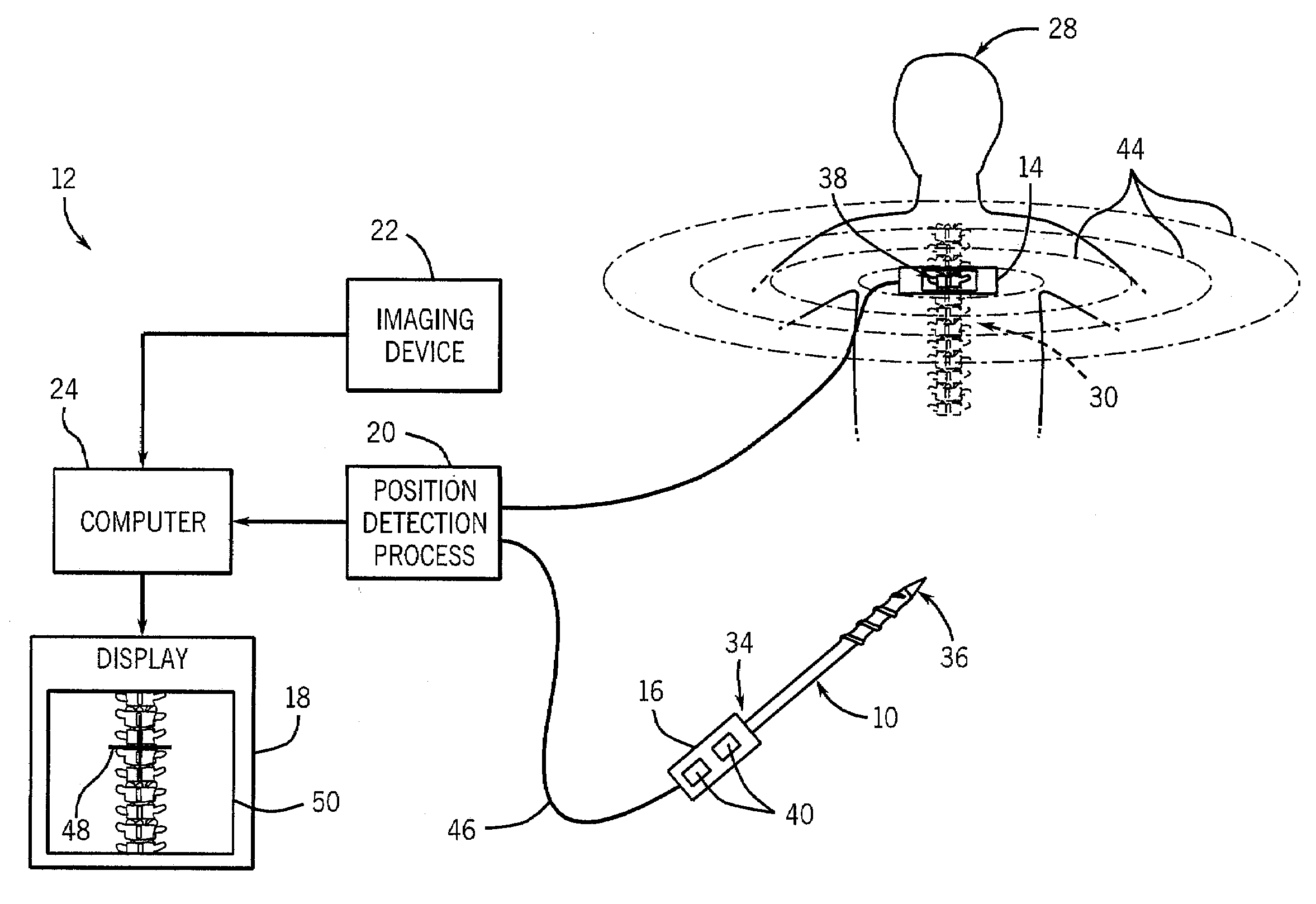 Method and apparatus for performing pedicle screw fusion surgery