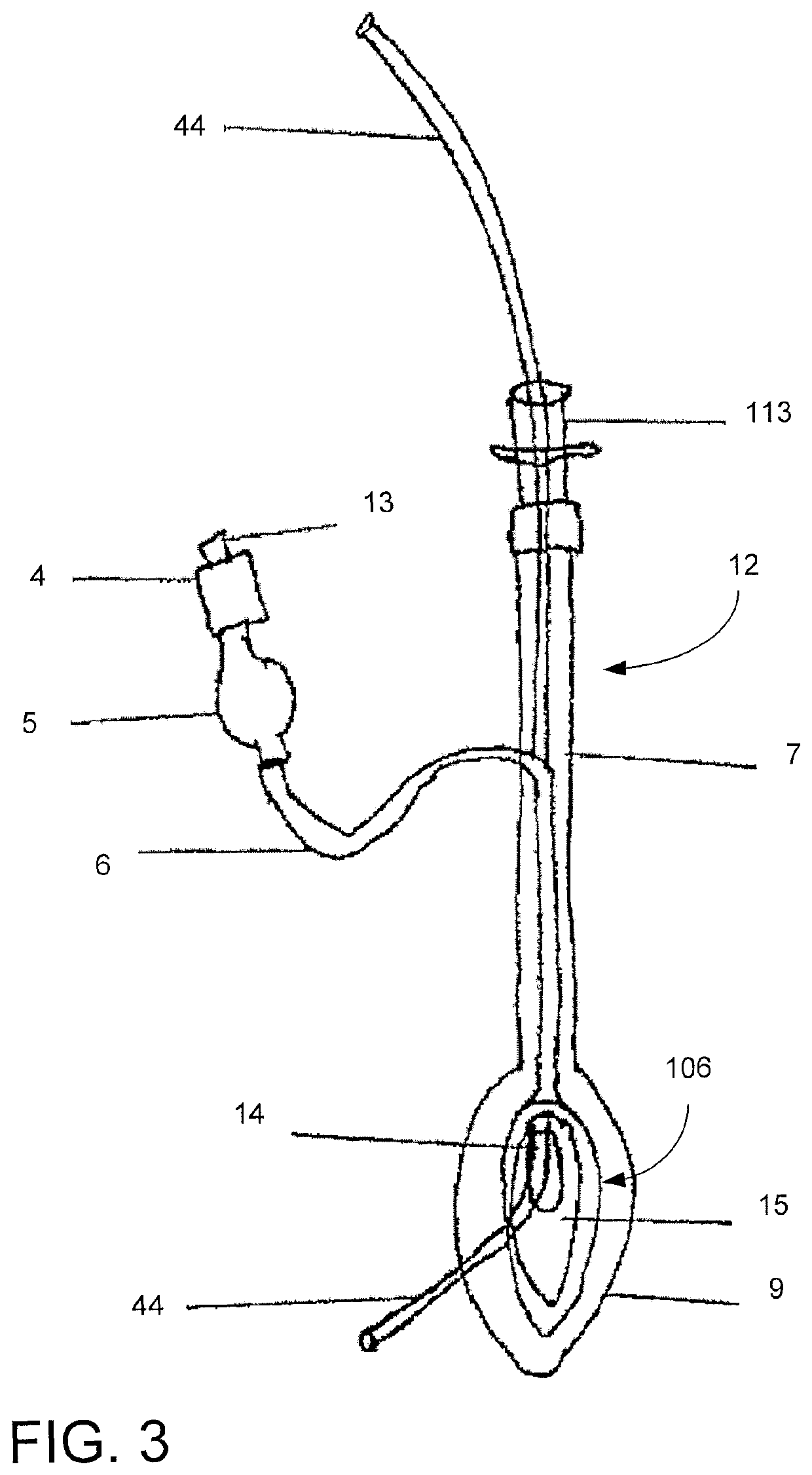 Neonatal laryngeal mask airway