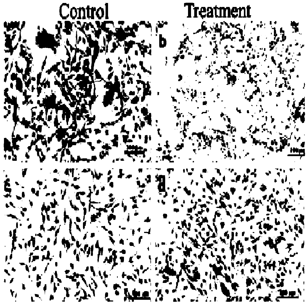 Method for inhibiting growth and metastasis of solid tumor cells and special pharmaceutical composition