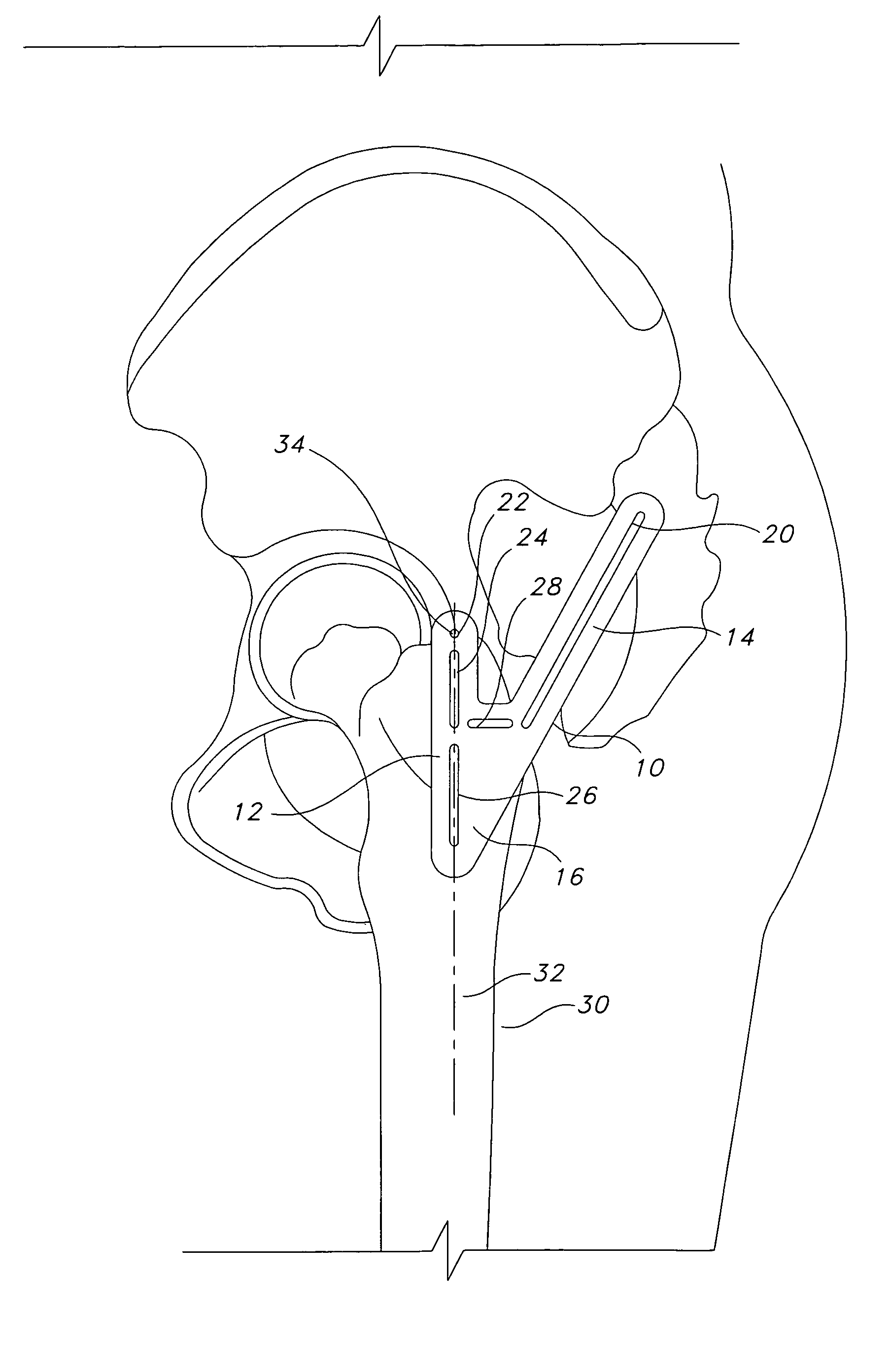 Hip replacement incision locator