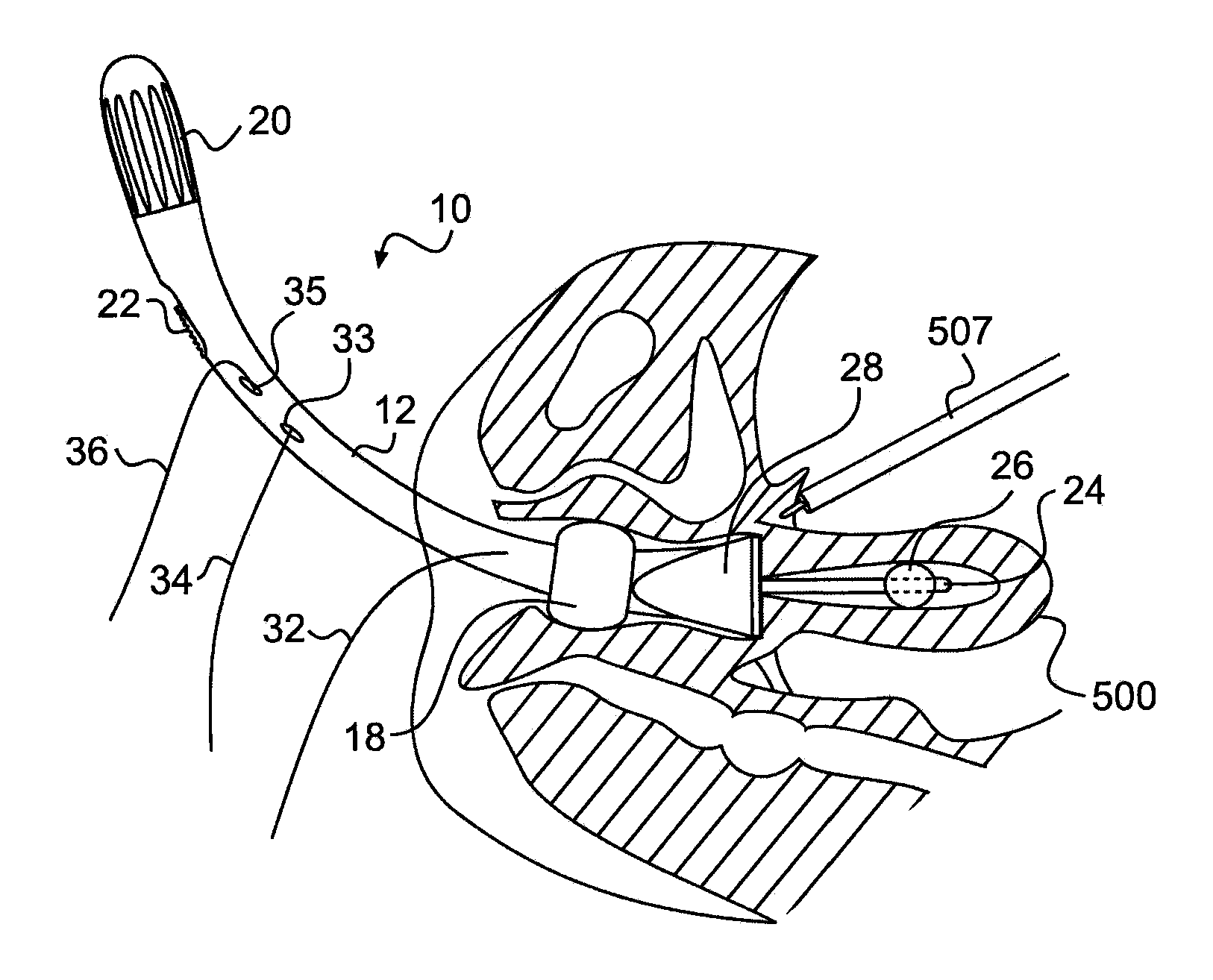 Apparatus for treating a portion of a reproductive system and related methods of use