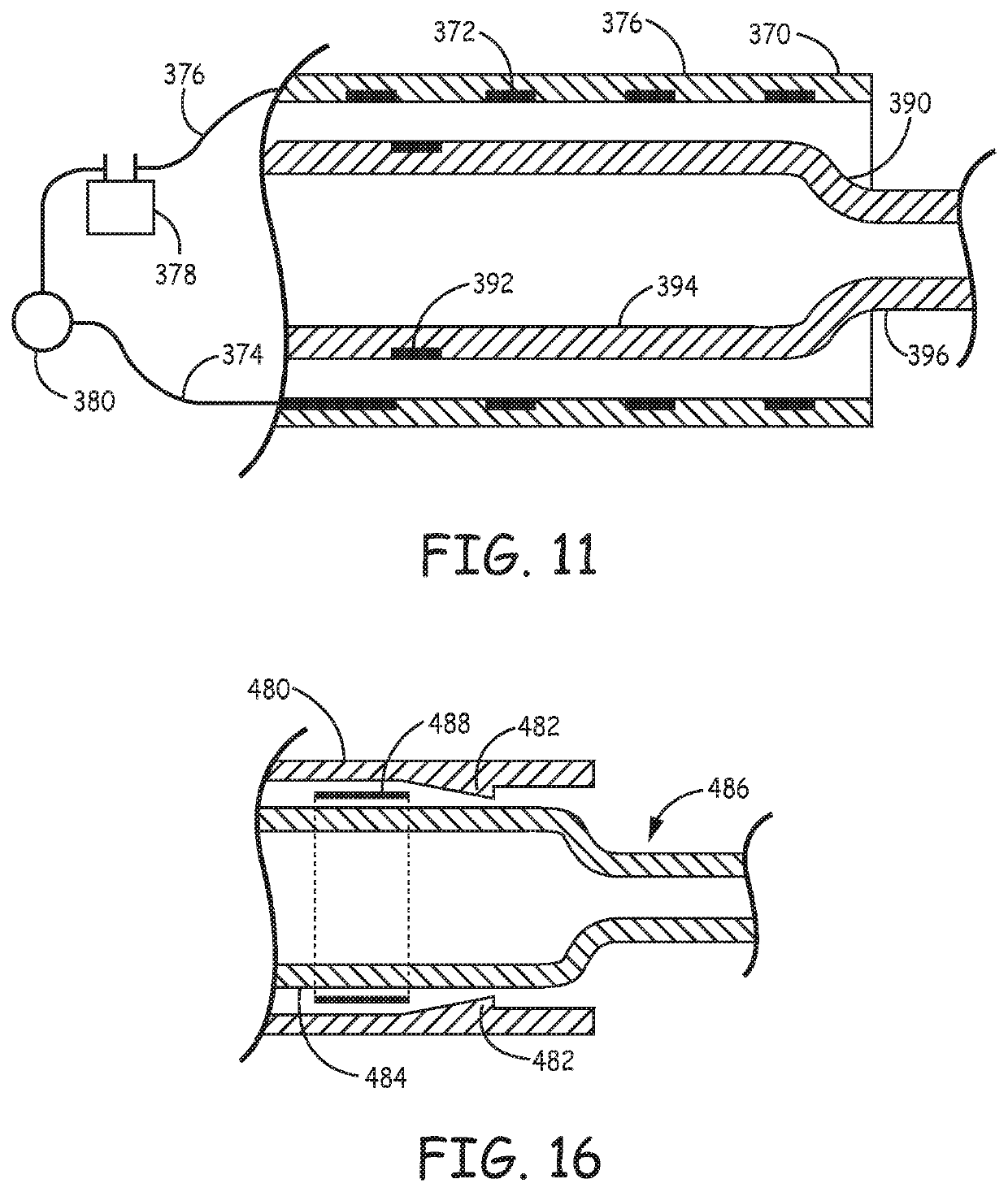 Catheter systems for applying effective suction in remote vessels and thrombectomy procedures facilitated by catheter systems