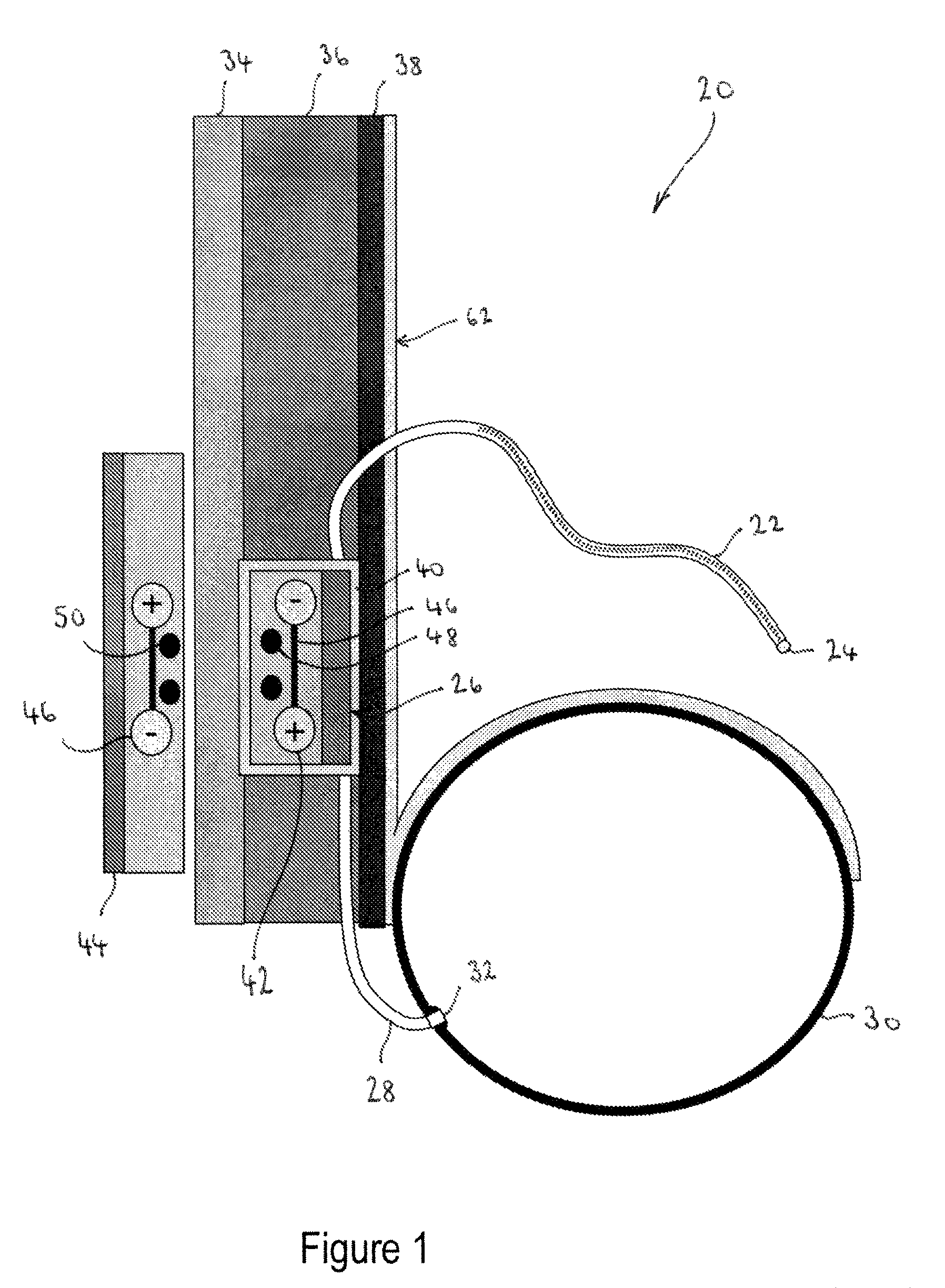 Implantable fluid management device for the removal of excess fluid