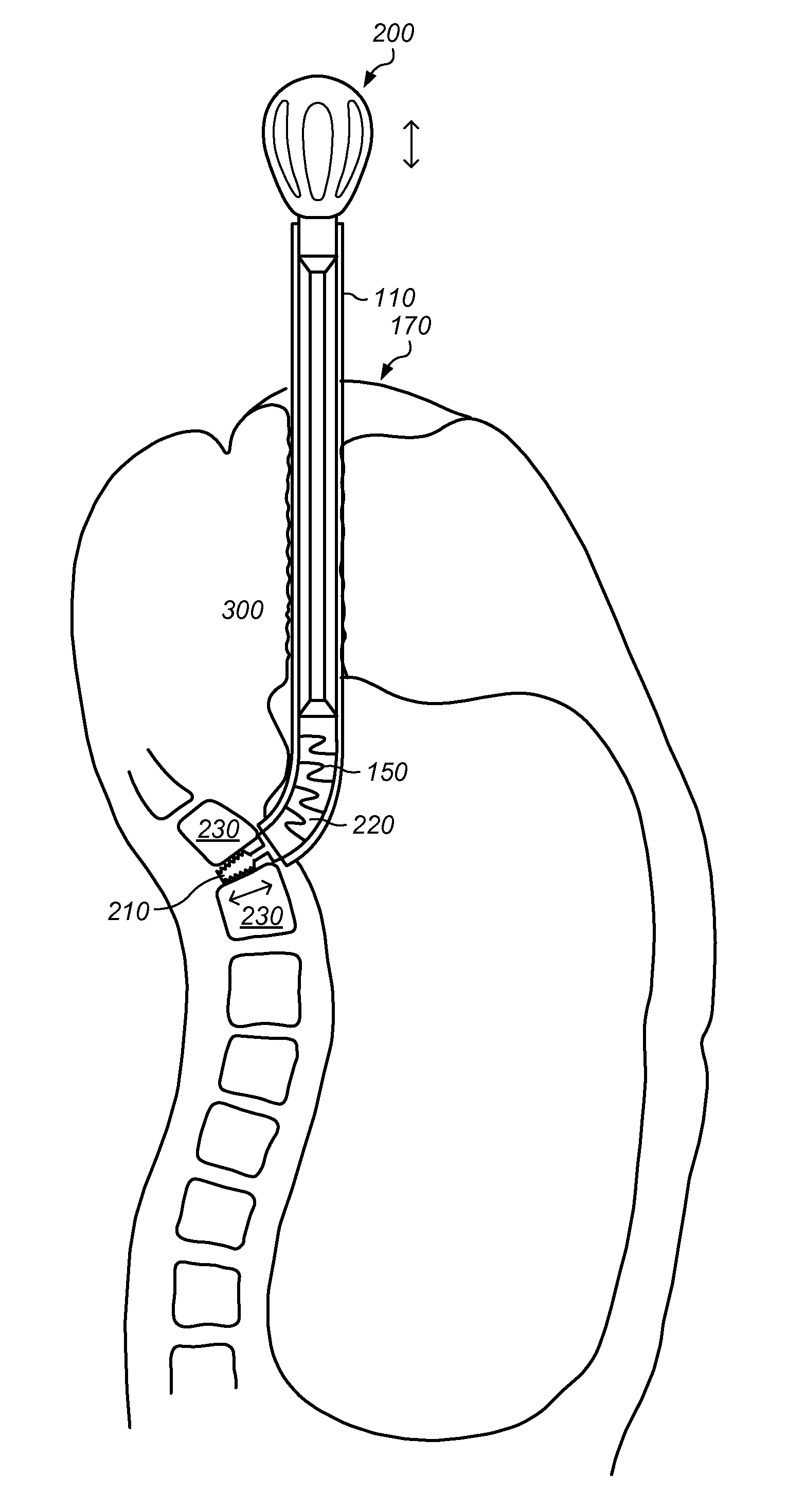 Method and system for performing spinal surgical procedures using natural orifices