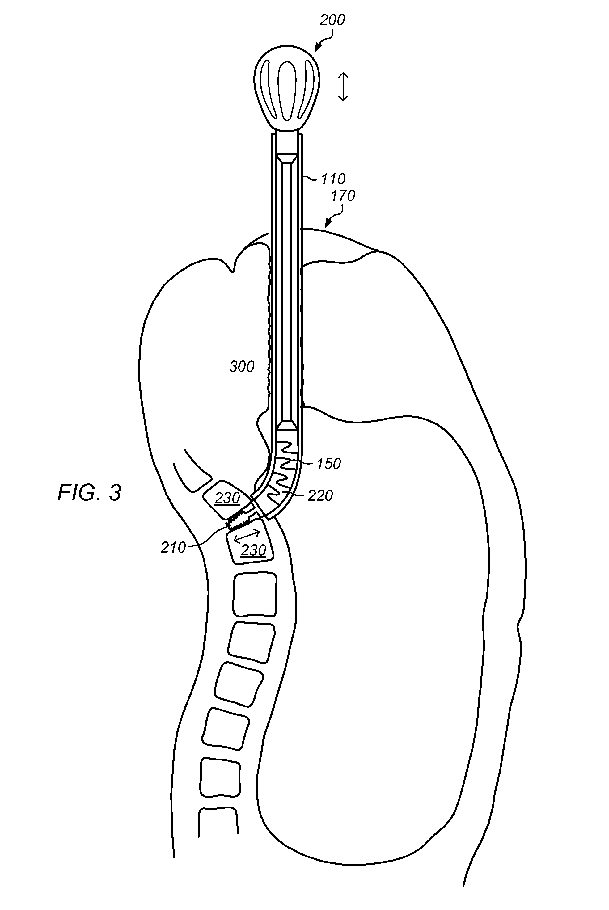 Method and system for performing spinal surgical procedures using natural orifices