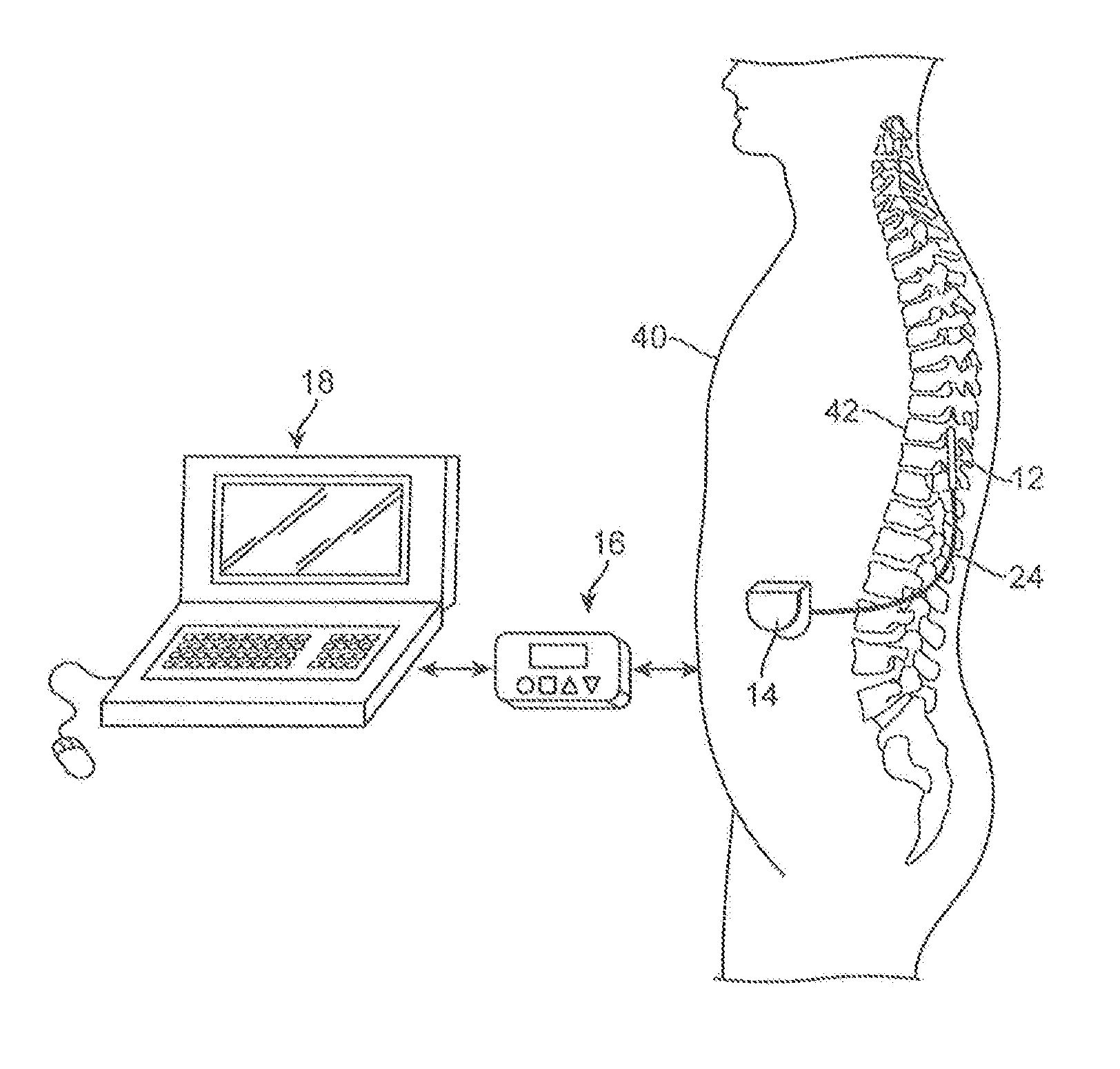 Electrode selection for sub-threshold modulation therapy