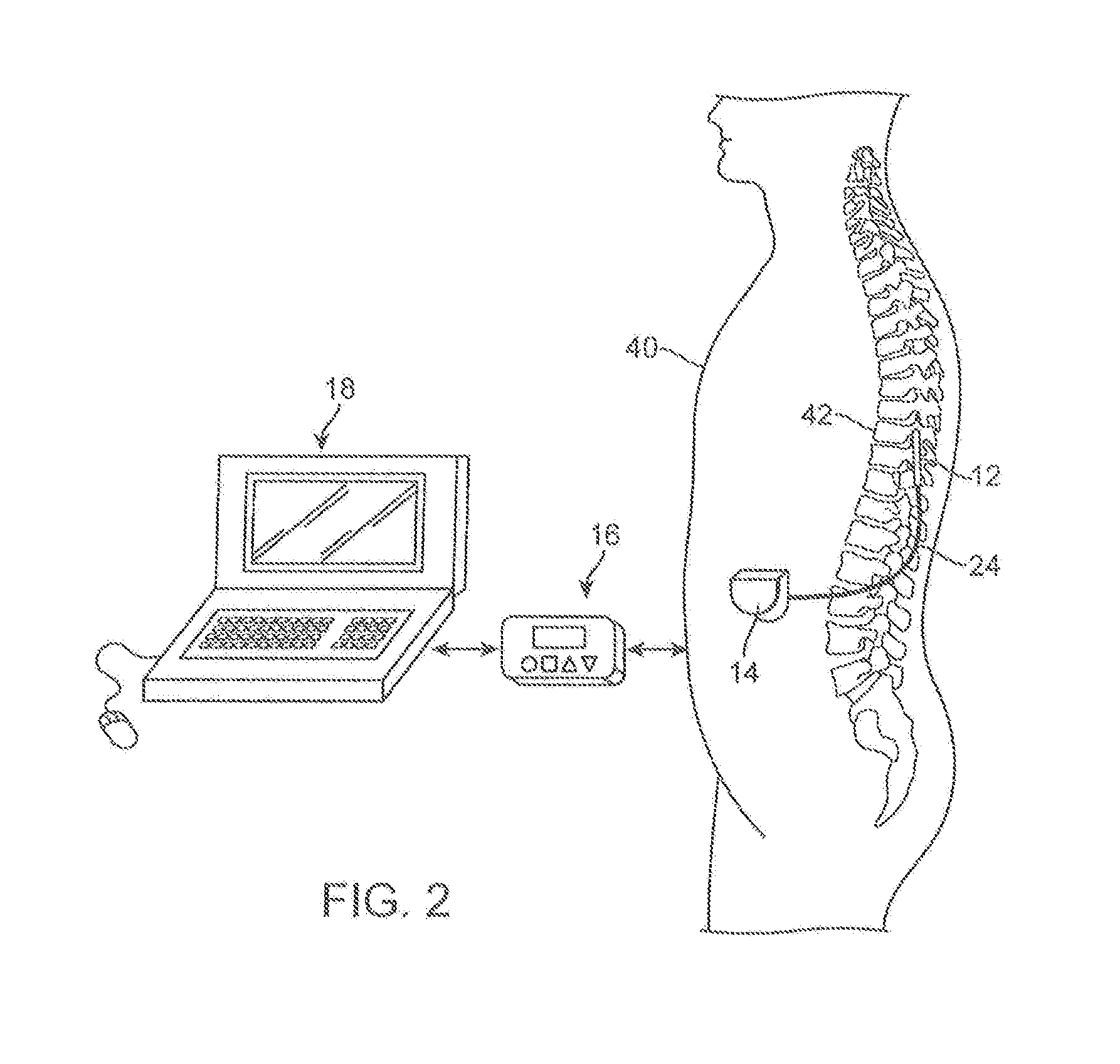 Electrode selection for sub-threshold modulation therapy