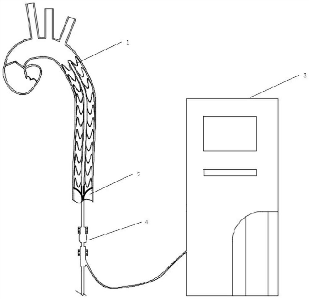 Intra-aortic balloon counterpulsation synergistic device with valve covered stent and using method