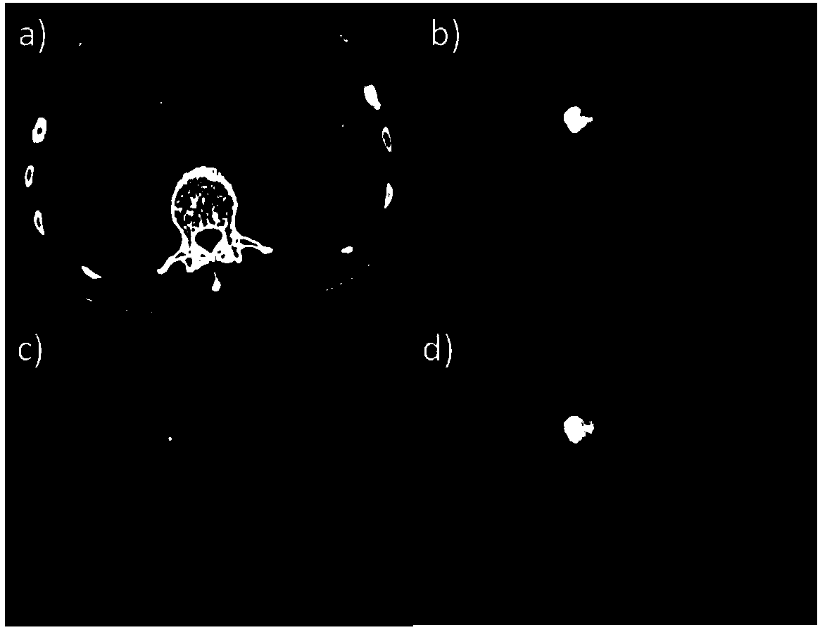 A method for intelligent assisted identification for diseases like pancreatic cancer and pancreatitis