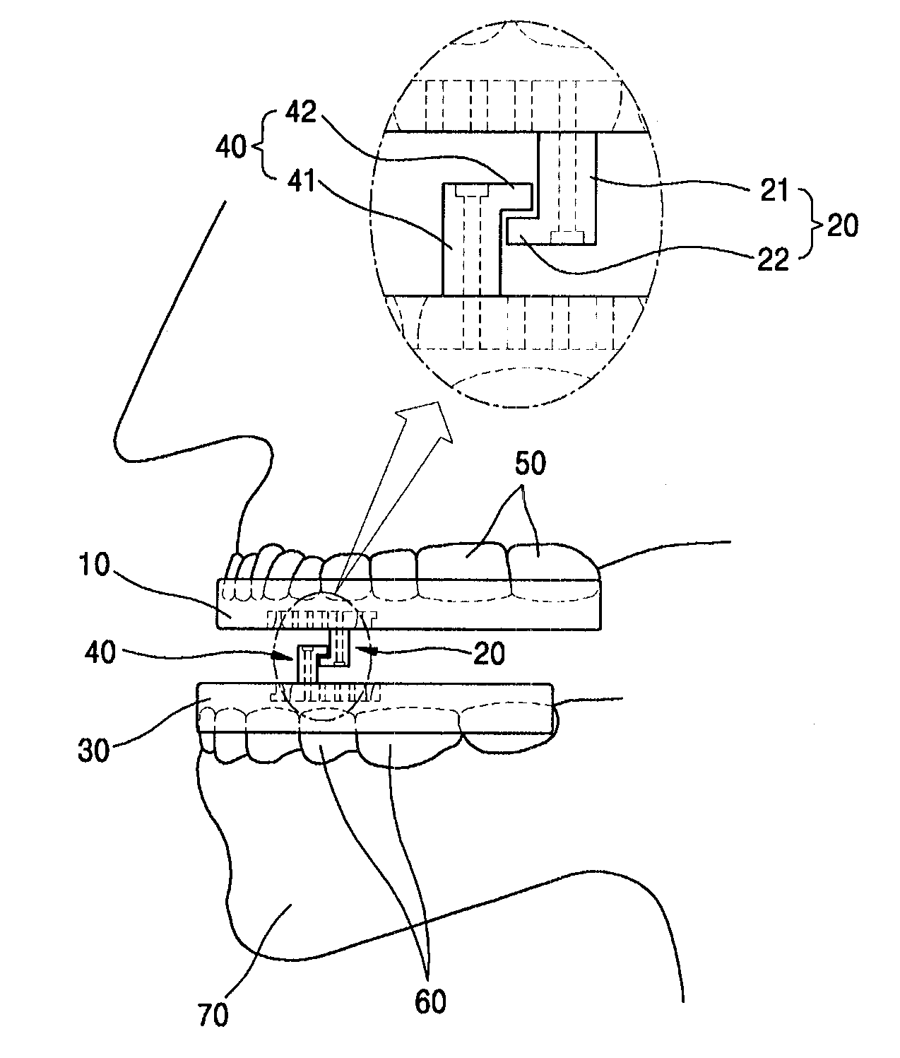 Device for snoring prevention