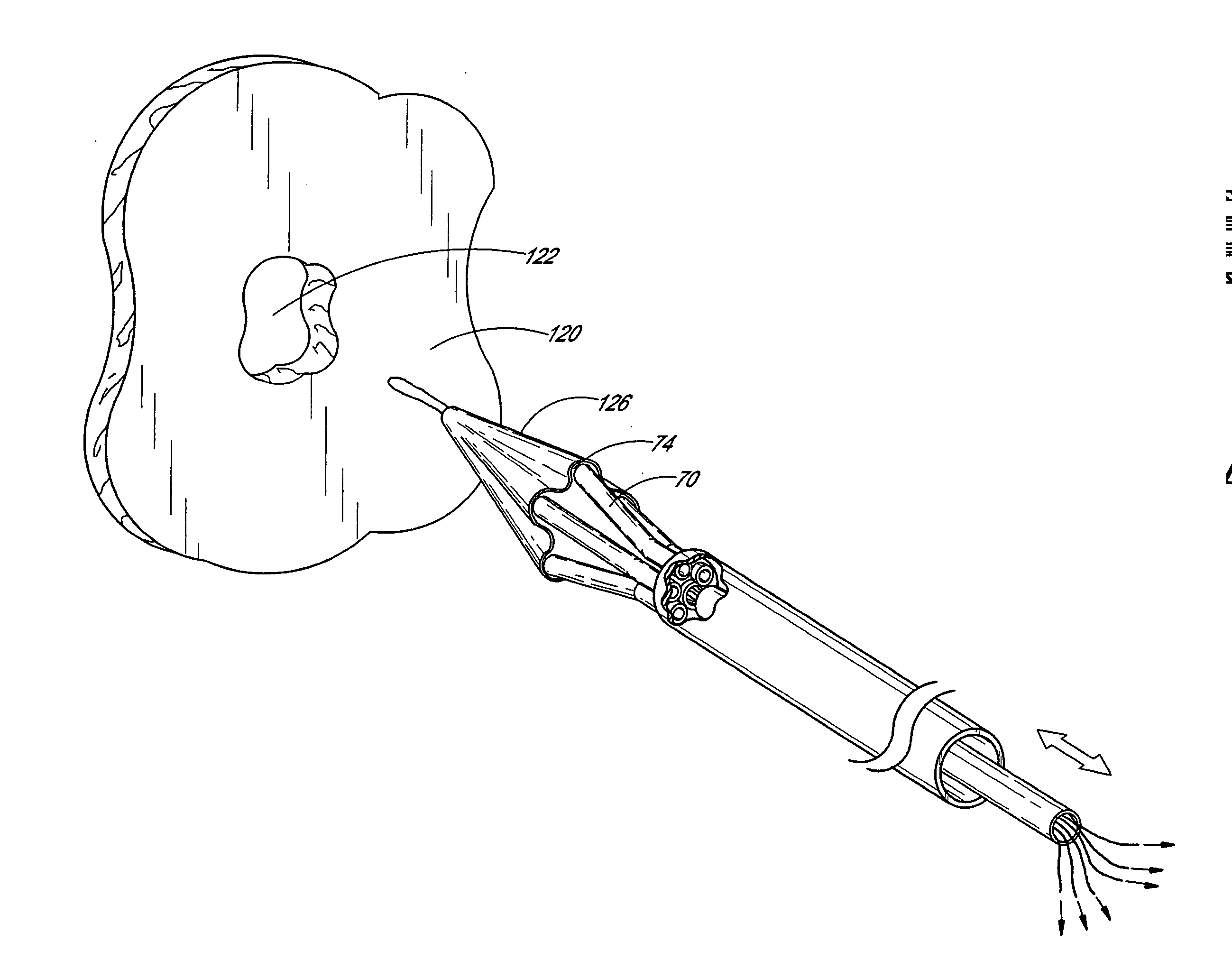 Method of closing an opening in a wall of the heart