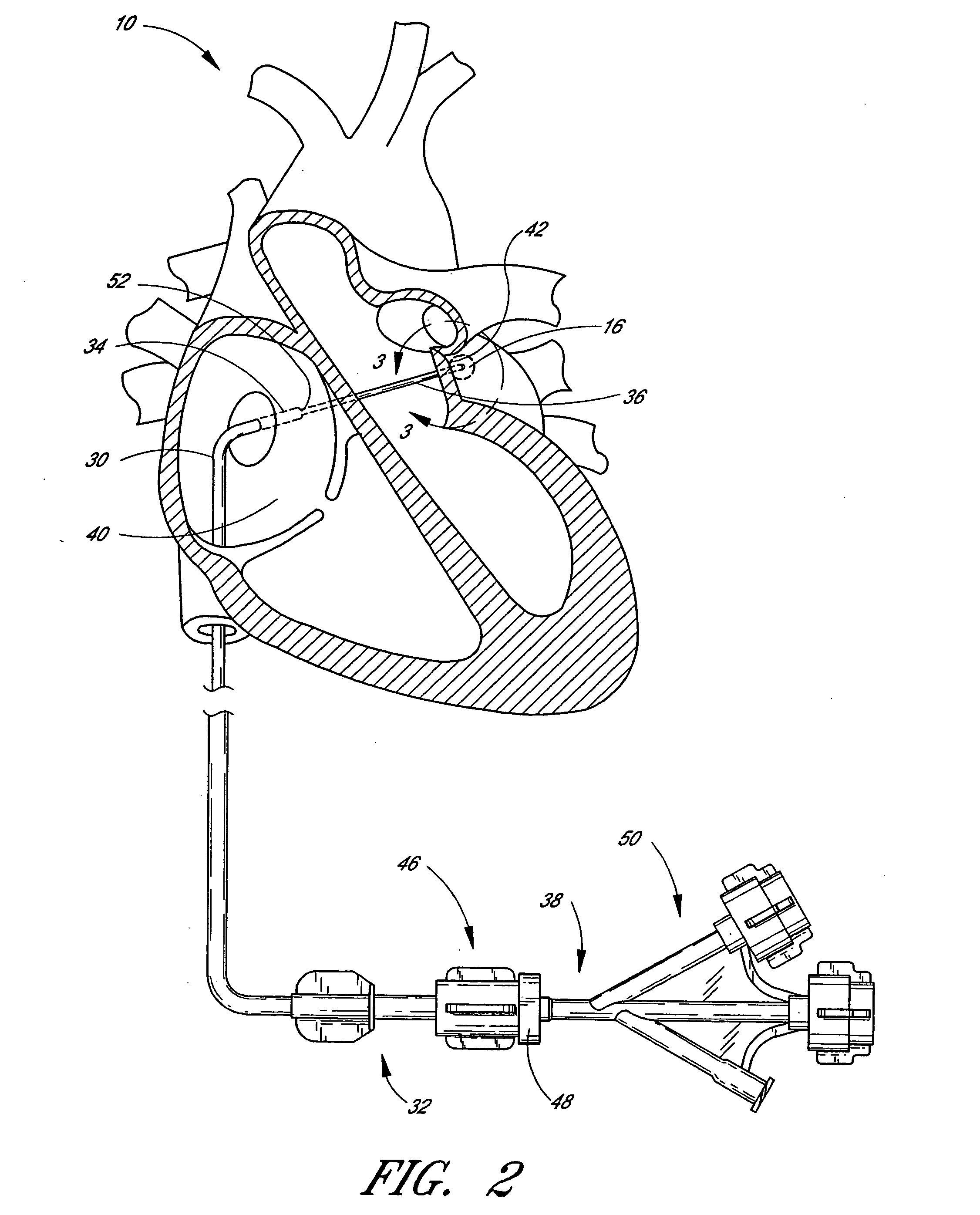 Method of closing an opening in a wall of the heart