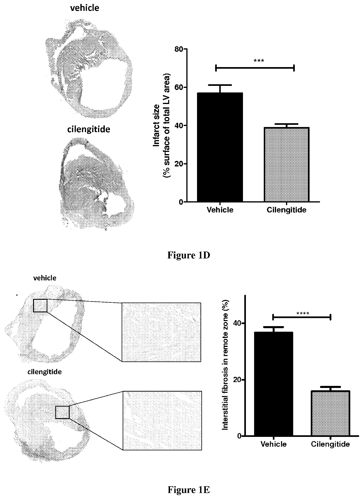 Use of alpha-v-integrin (CD51) inhibitors for the treatment of cardiac fibrosis