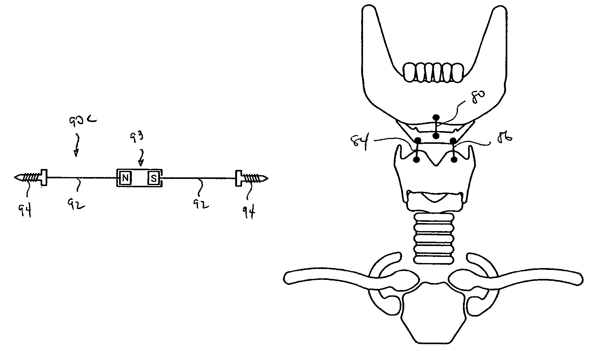 Devices and methods for treating sleep disorders