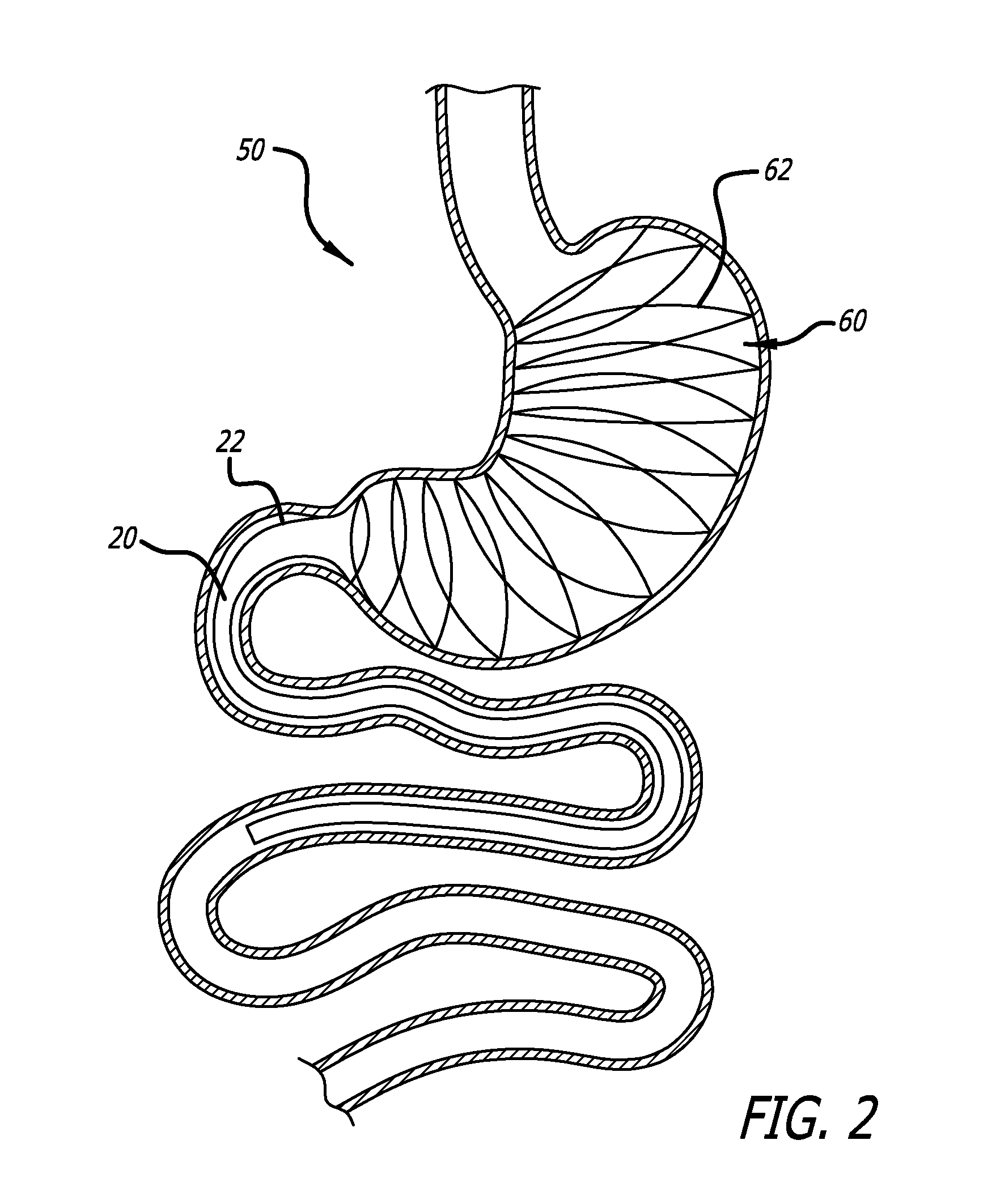 Methods And Devices For Anchoring A Gastroenterologic Sleeve