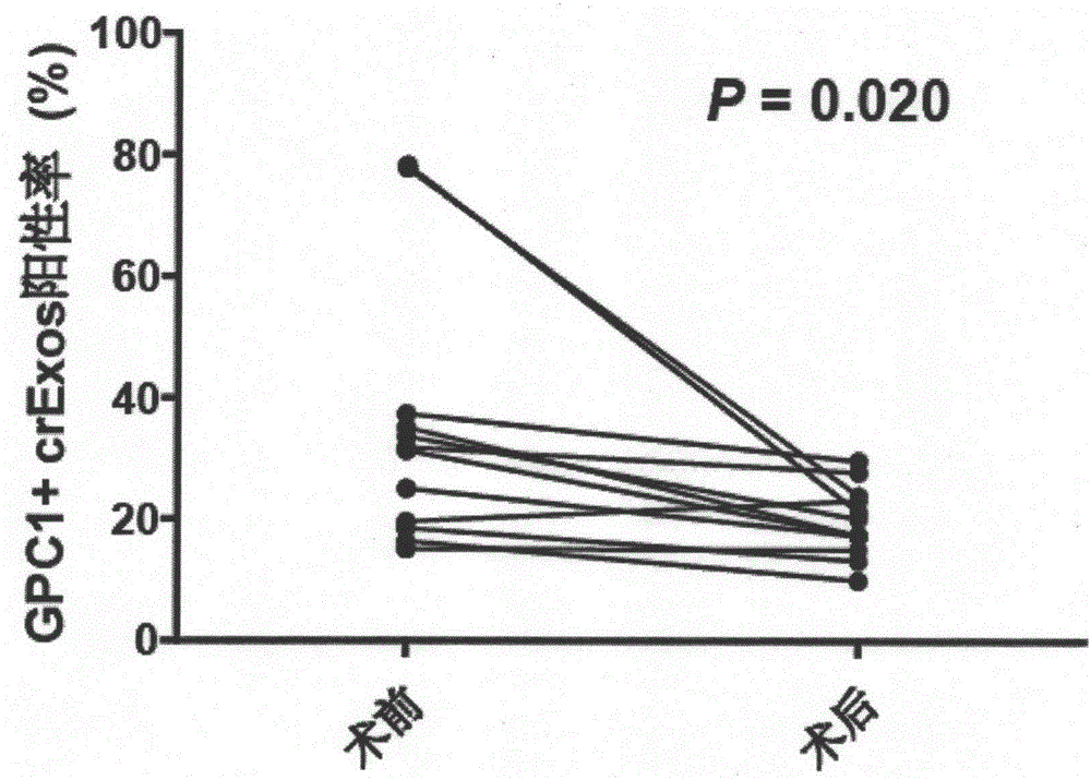 Application of GPC1 as tumor diagnosis marker