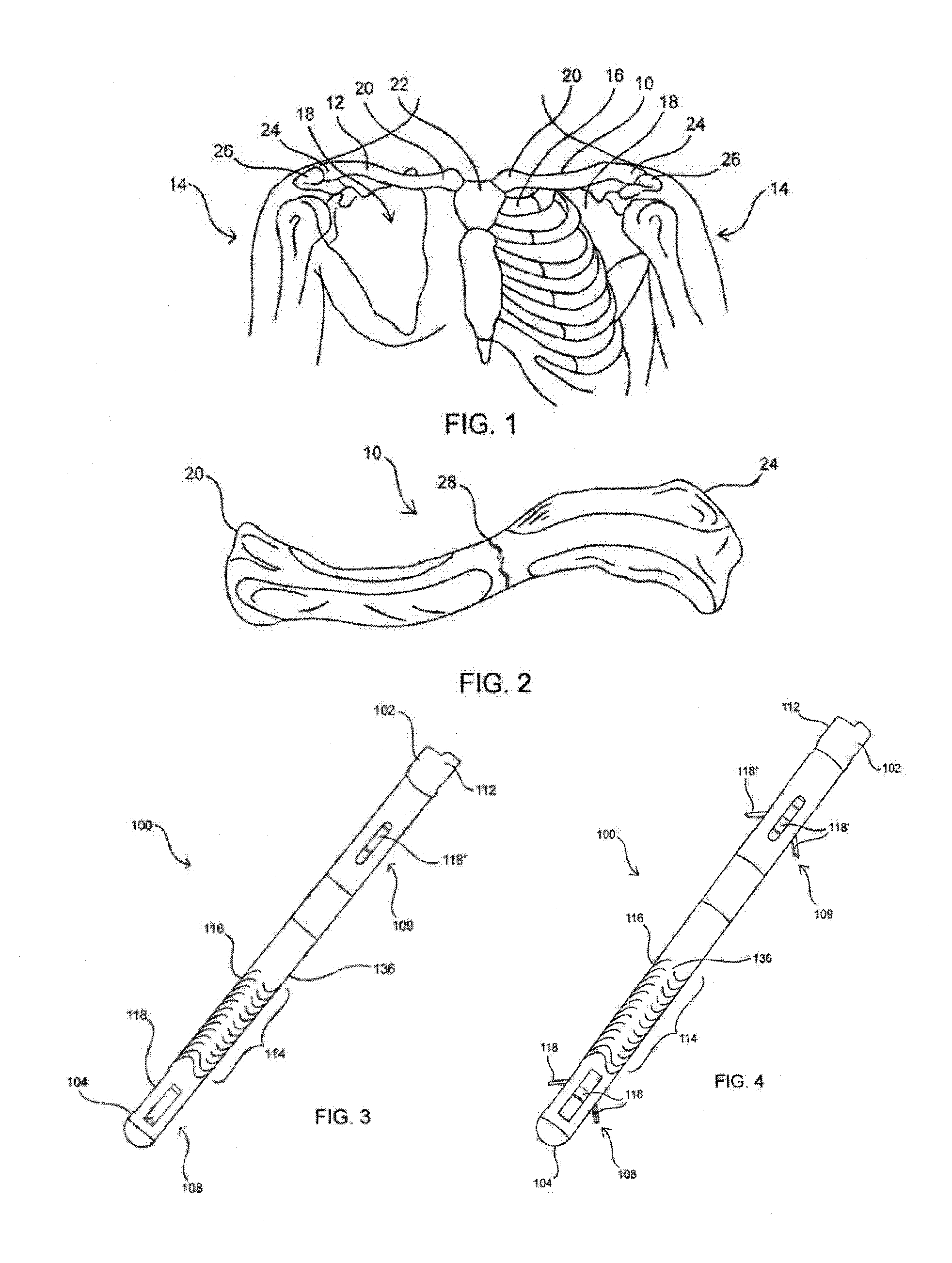 Straight intramedullary fracture fixation devices and methods