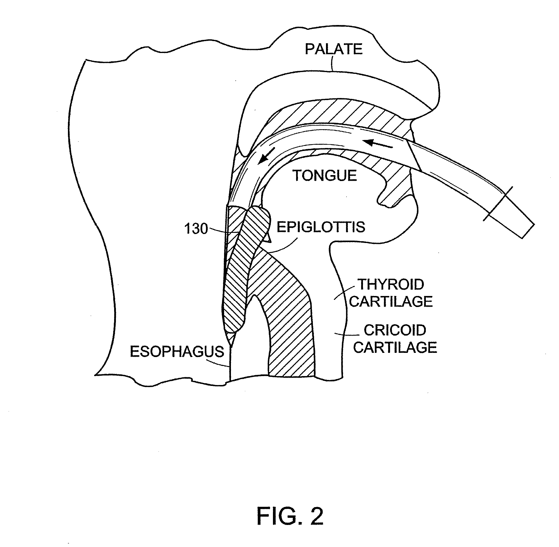 Disposable laryngeal mask airway device